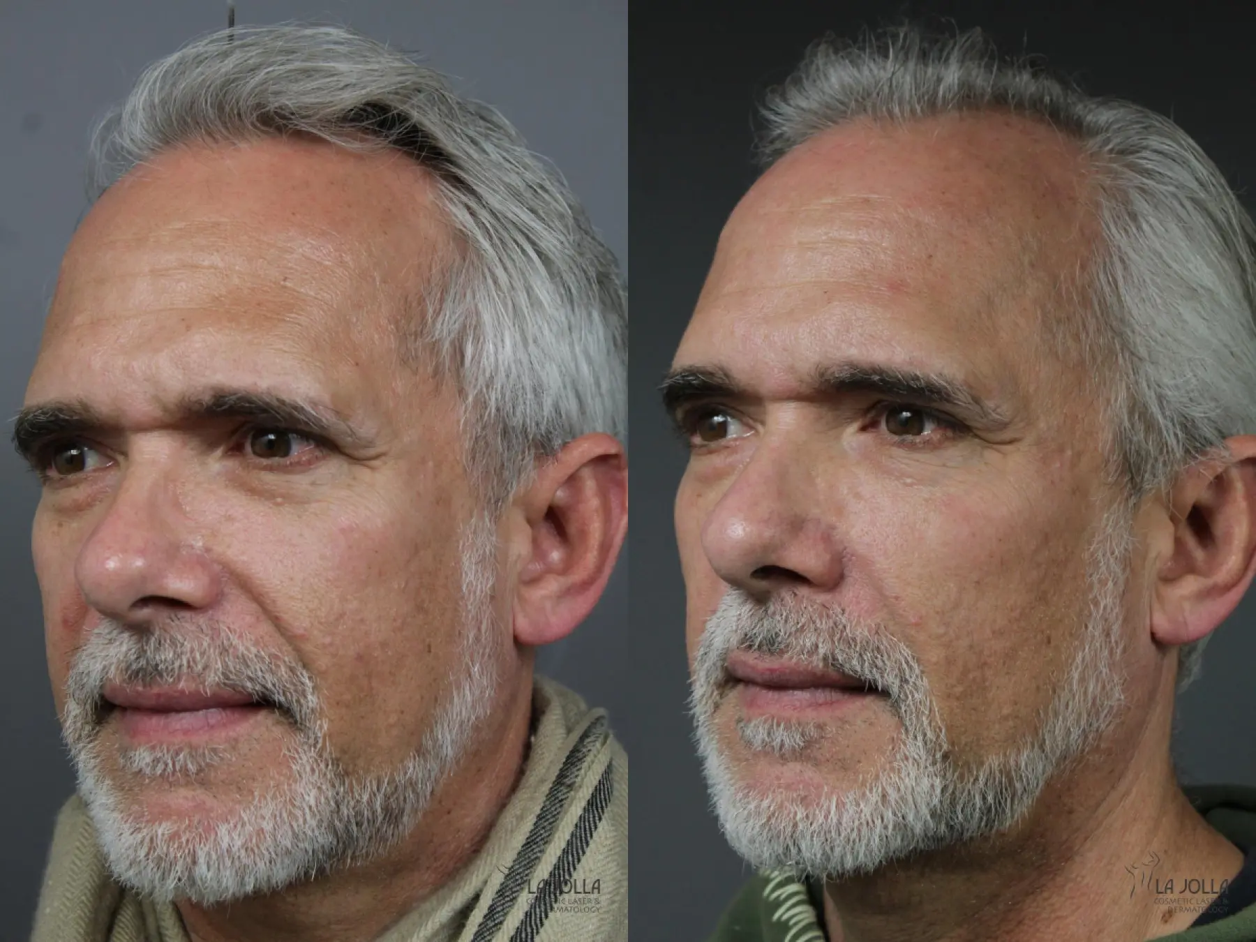 Sculptra®: Patient 1 - Before and After 2