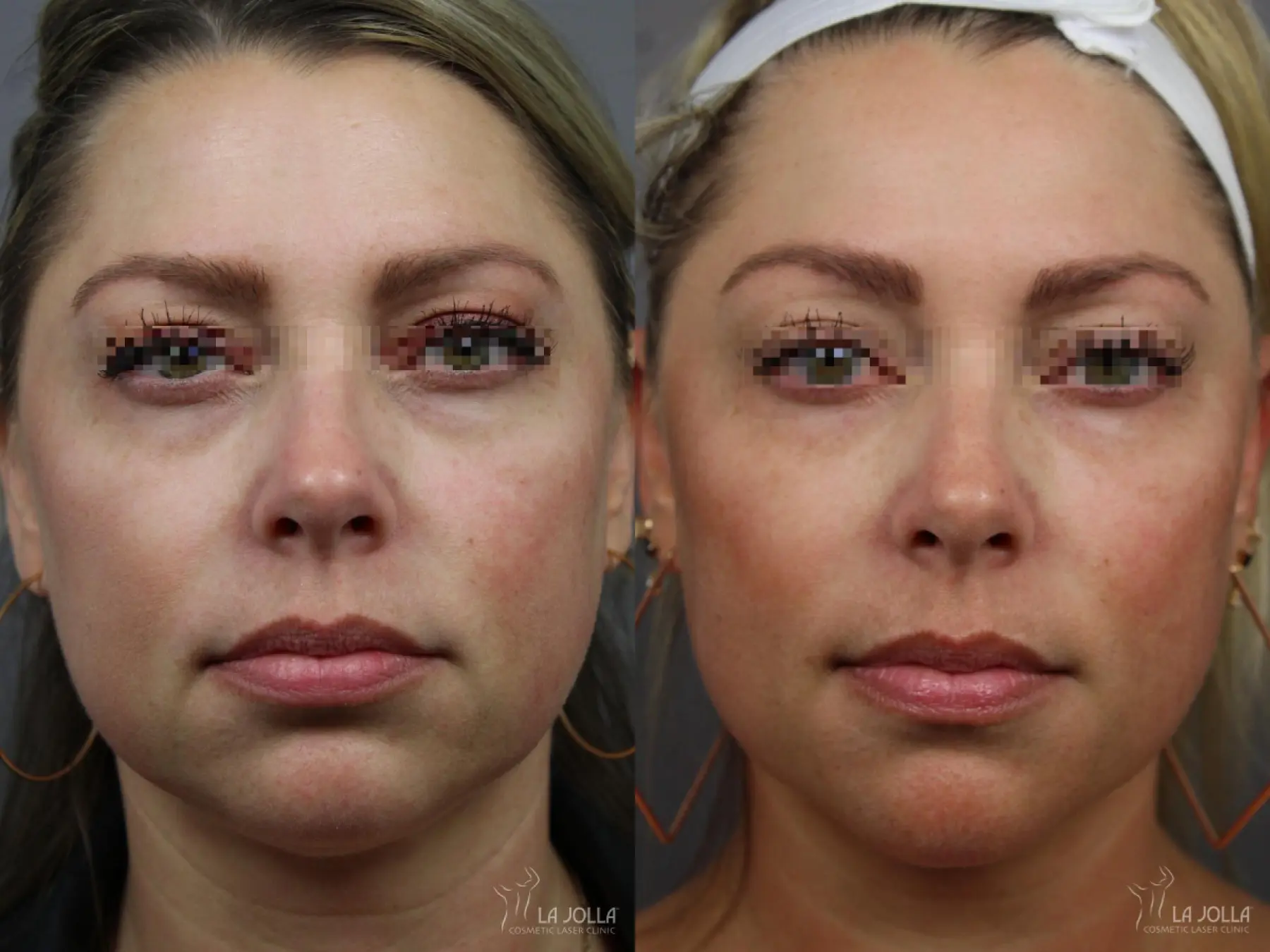 Sculptra®: Patient 6 - Before and After 1