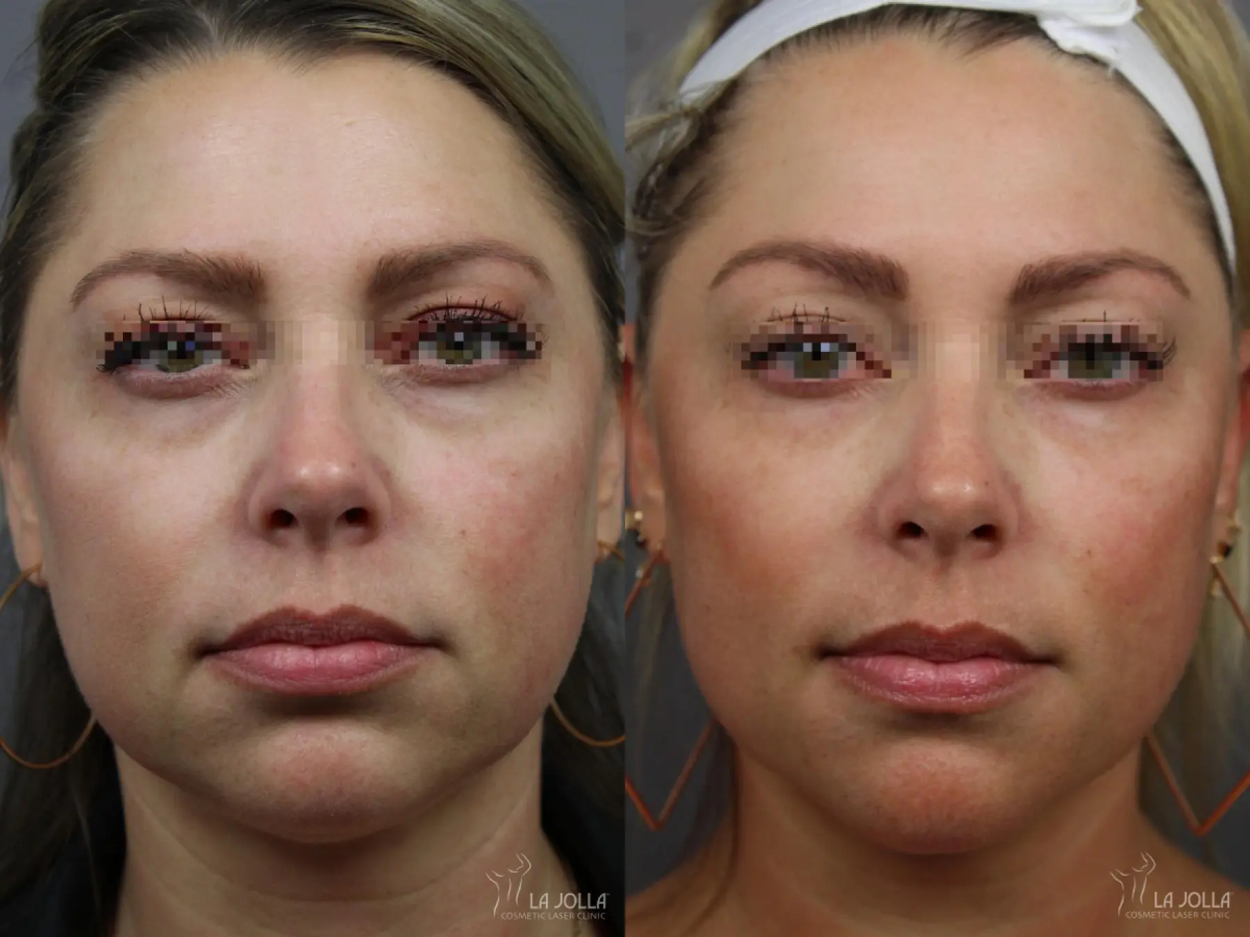 Sculptra®: Patient 9 - Before and After  