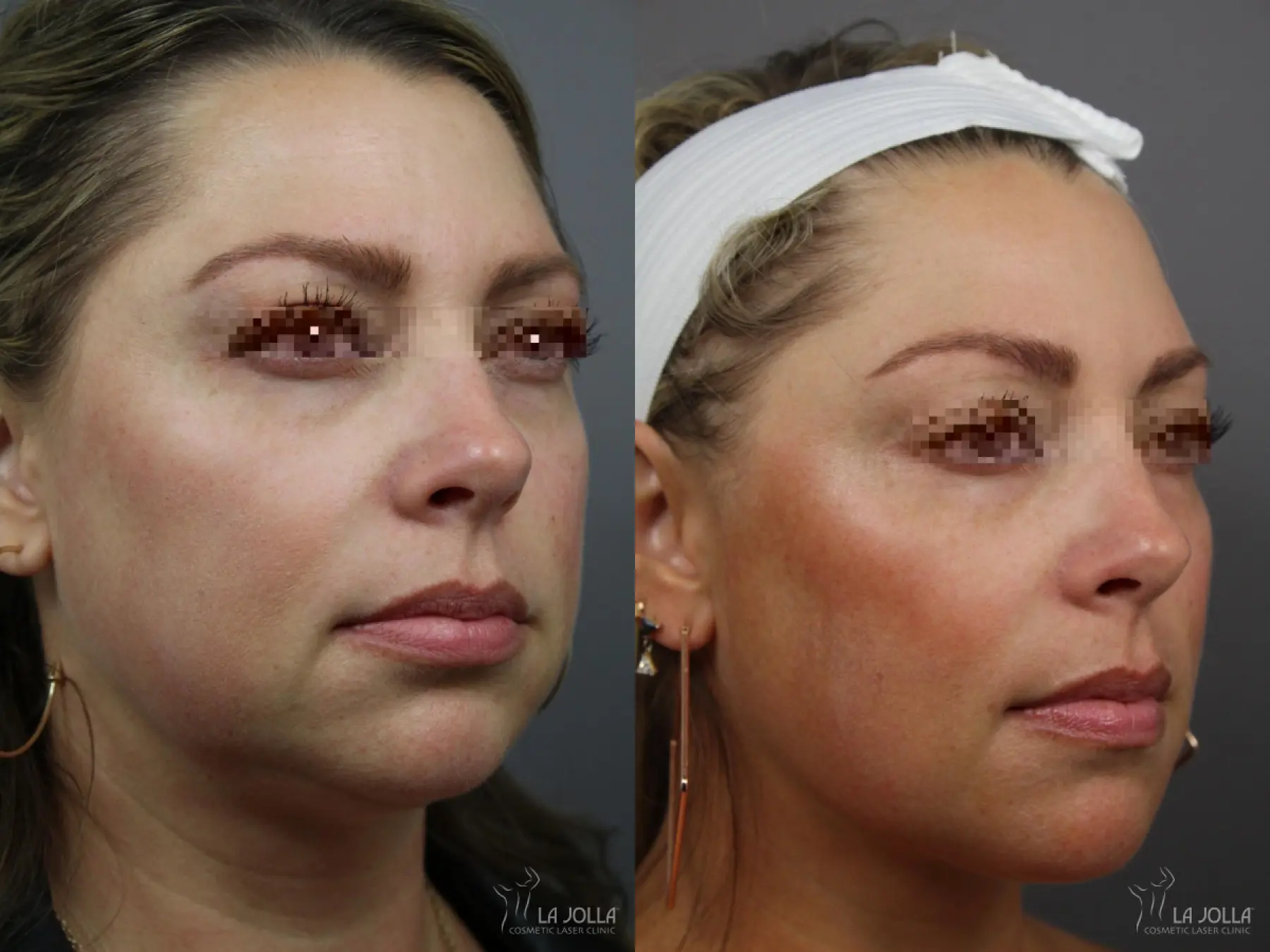 Sculptra®: Patient 17 - Before and After 1