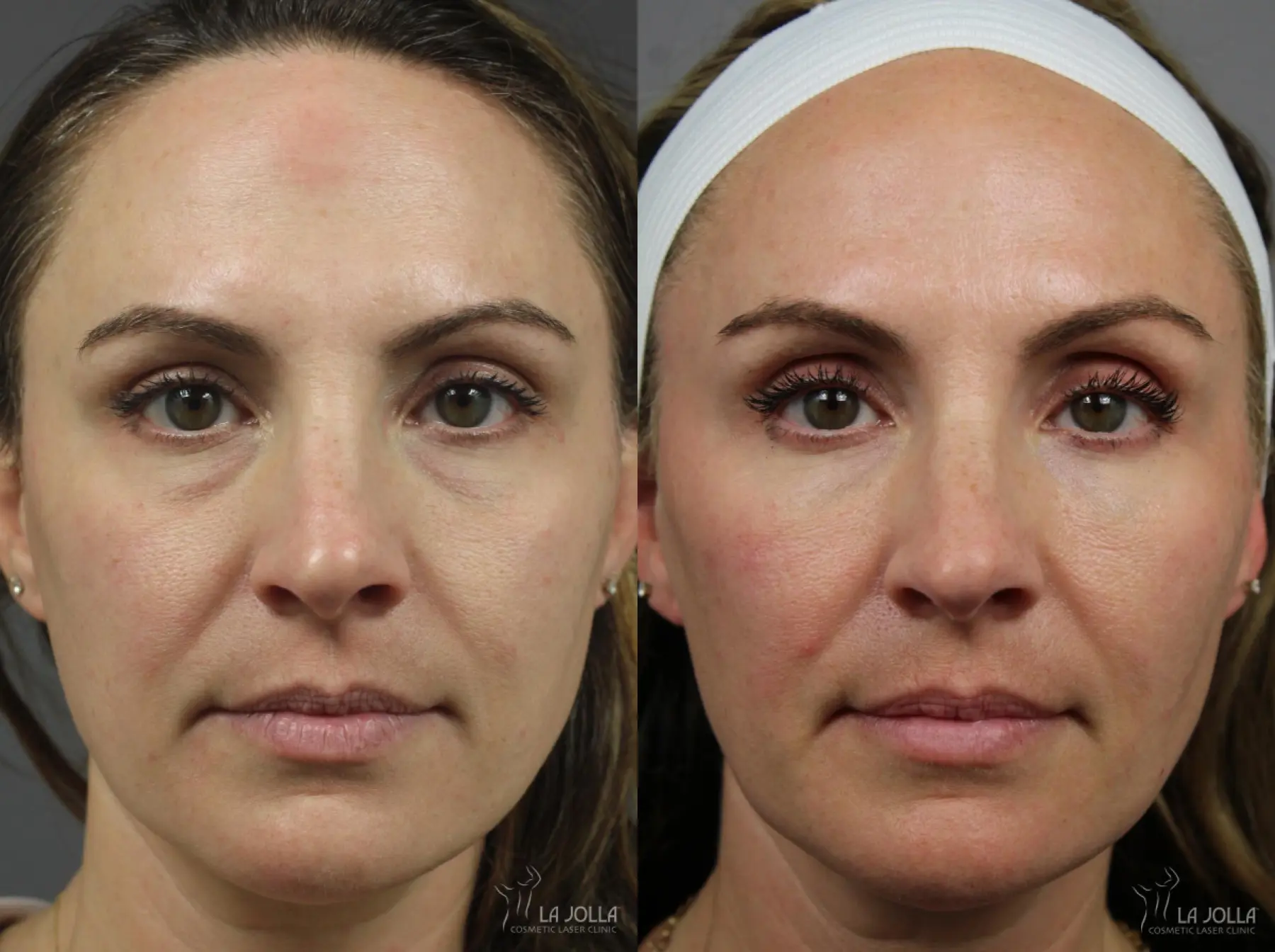 Sculptra®: Patient 5 - Before and After  