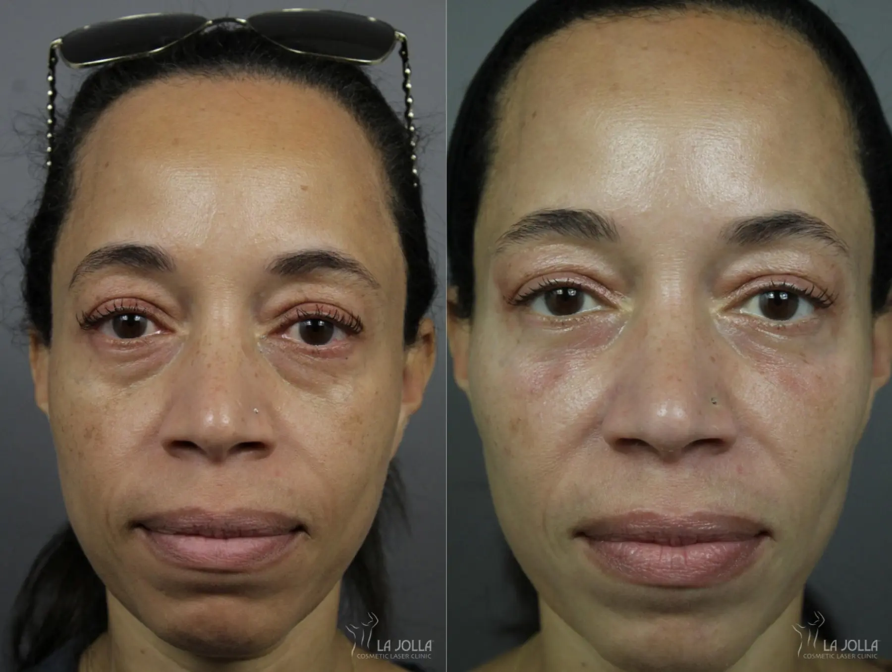 Sculptra®: Patient 3 - Before and After  