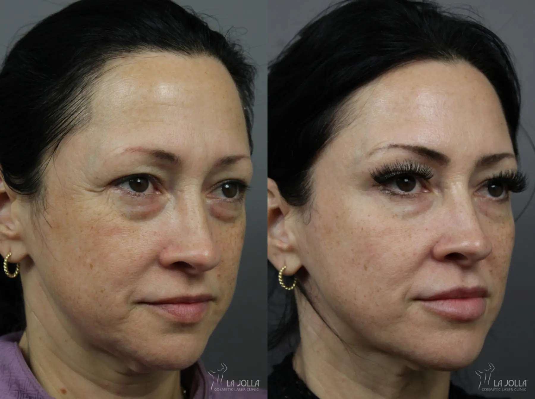 Sculptra®: Patient 7 - Before and After  