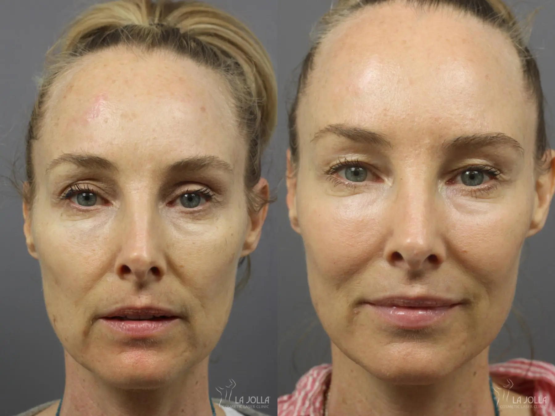 Sculptra®: Patient 20 - Before and After 1