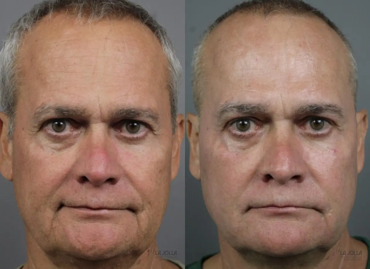 Sculptra®: Patient 2 - Before and After 1
