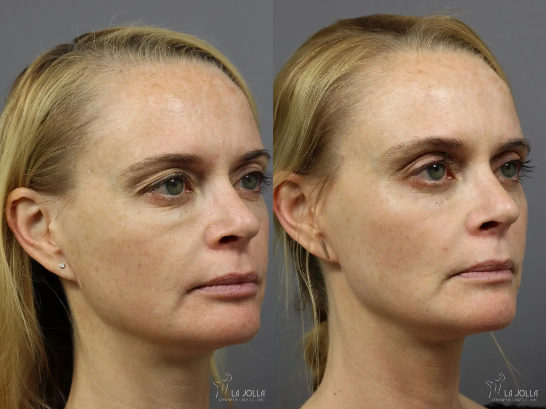 Sculptra®: Patient 14 - Before and After 1