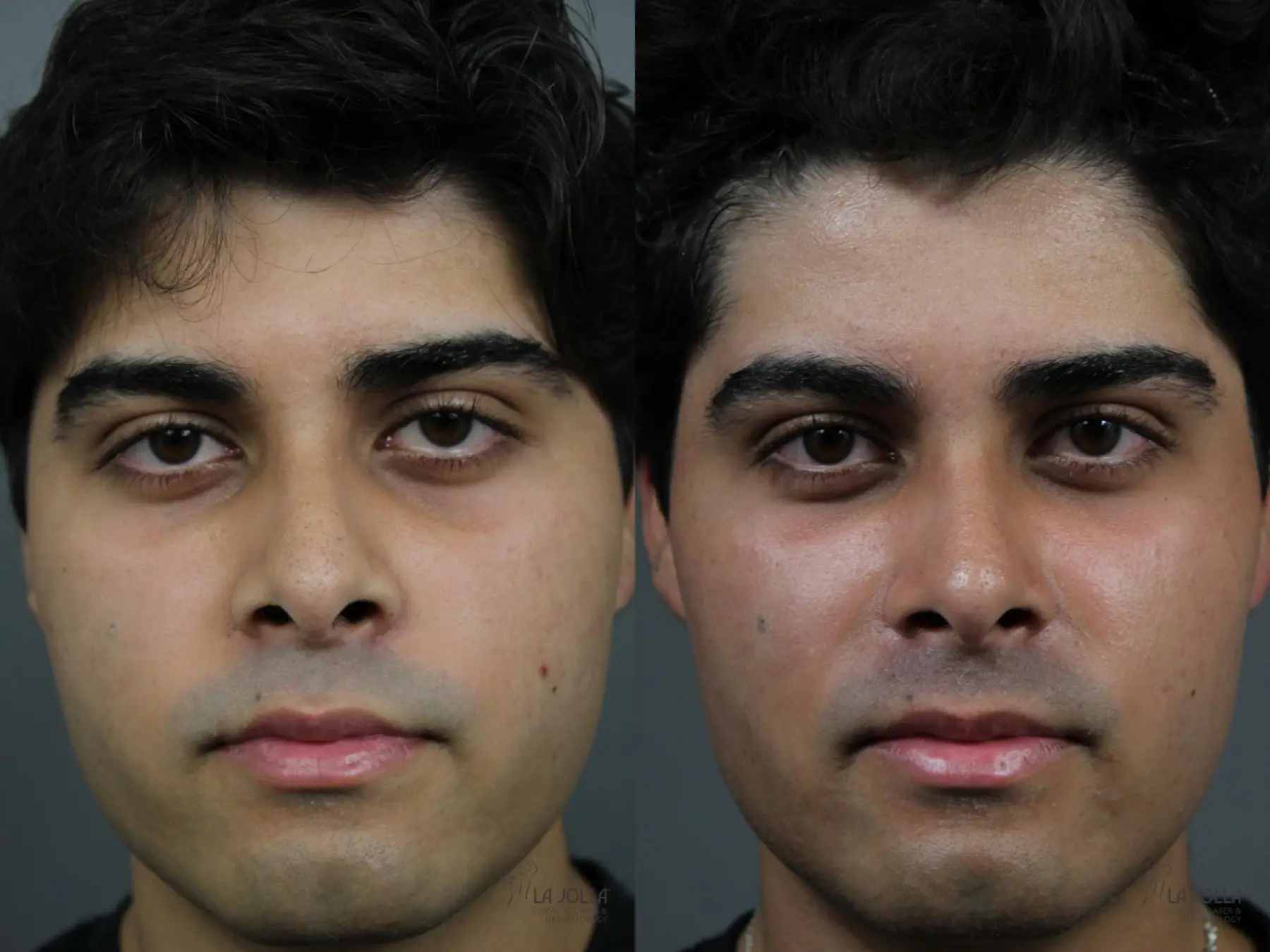 Sculptra®: Patient 2 - Before and After