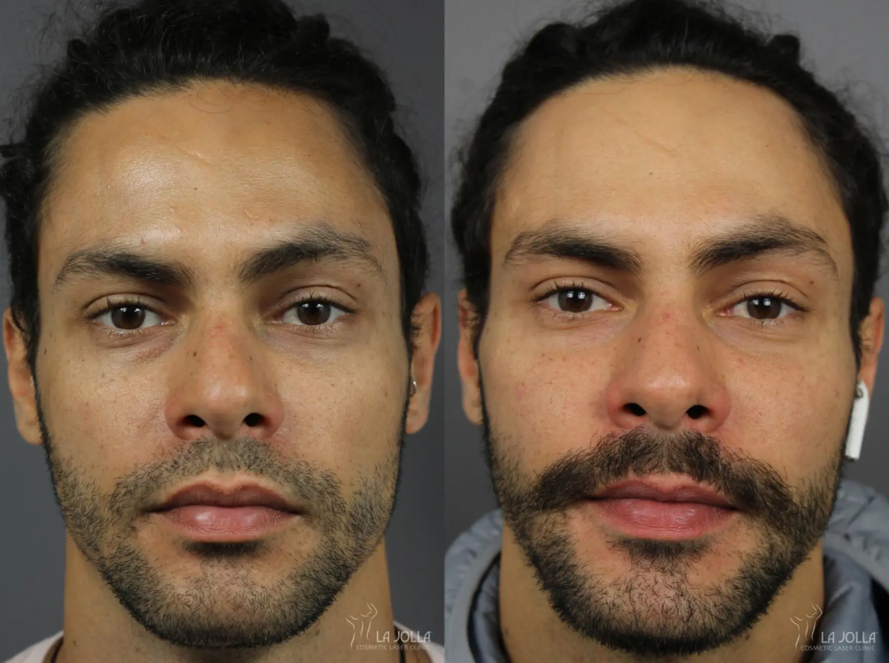 Sculptra®: Patient 6 - Before and After  