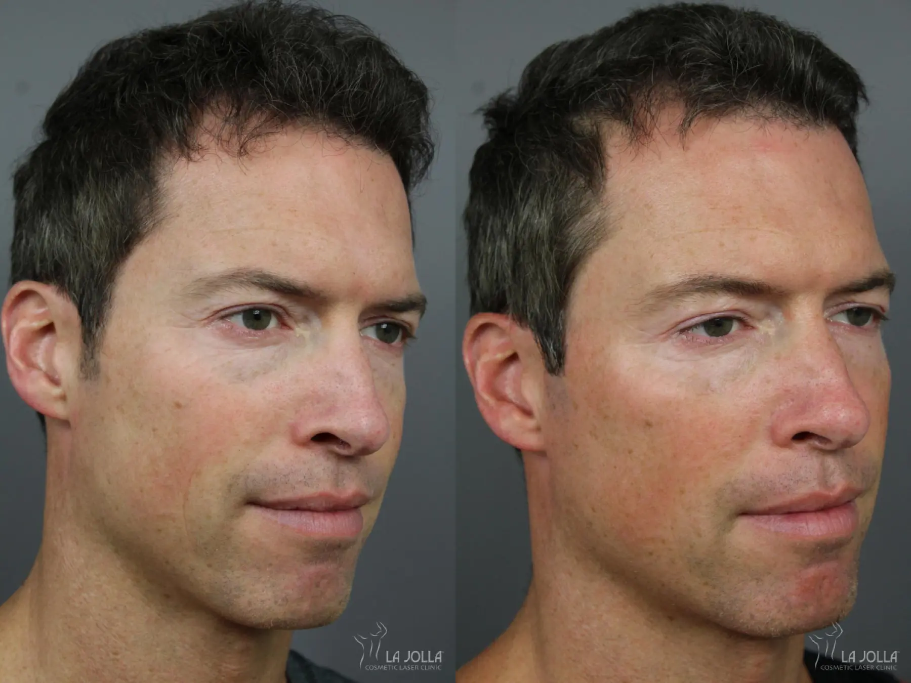 Sculptra®: Patient 17 - Before and After 1
