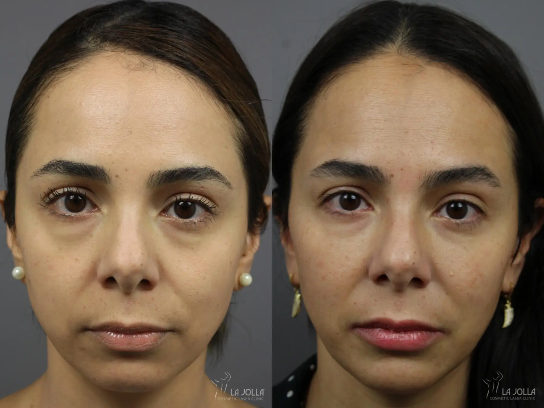 Sculptra®: Patient 13 - Before and After 1