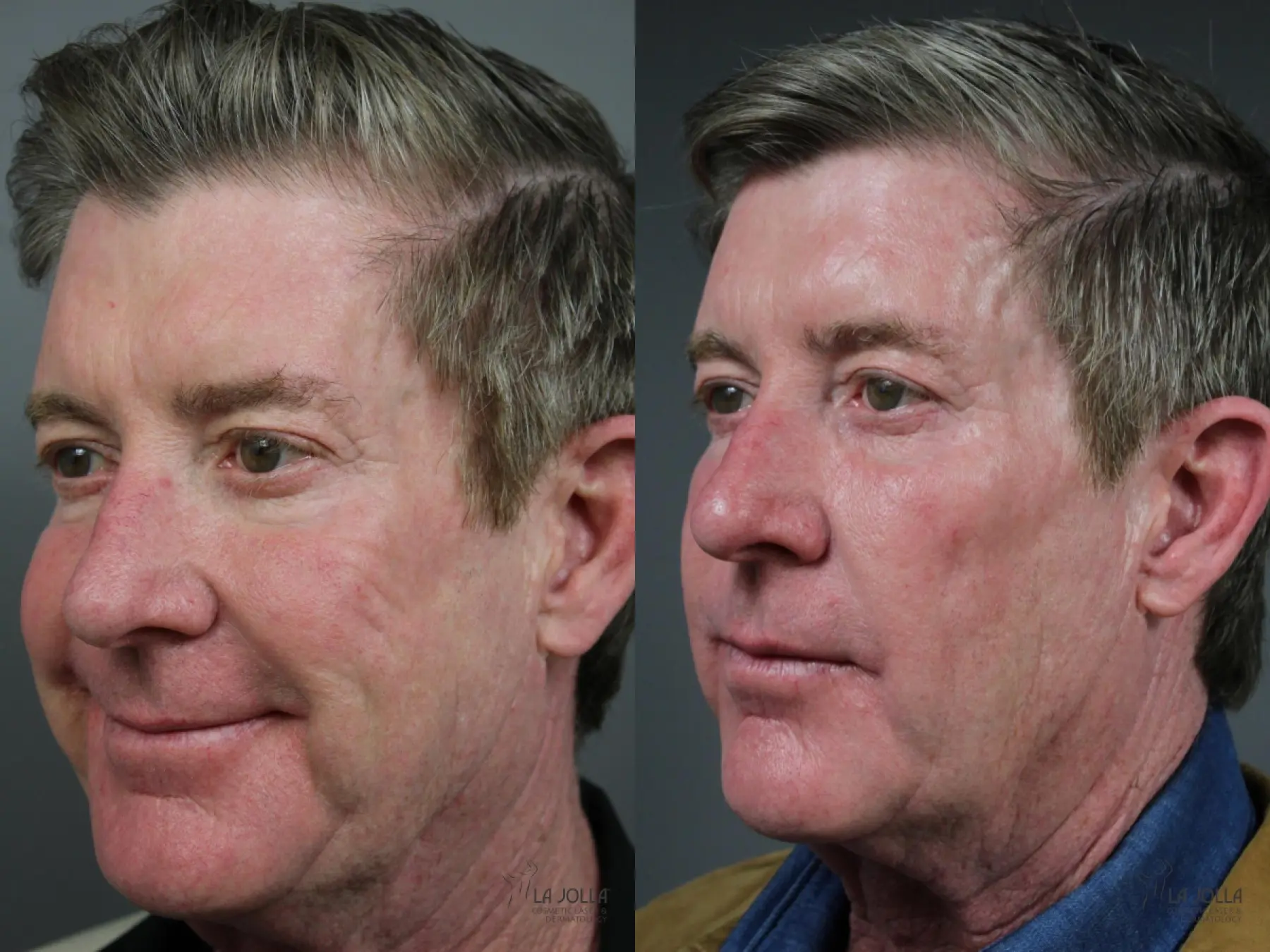 Sculptra®: Patient 2 - Before and After 2