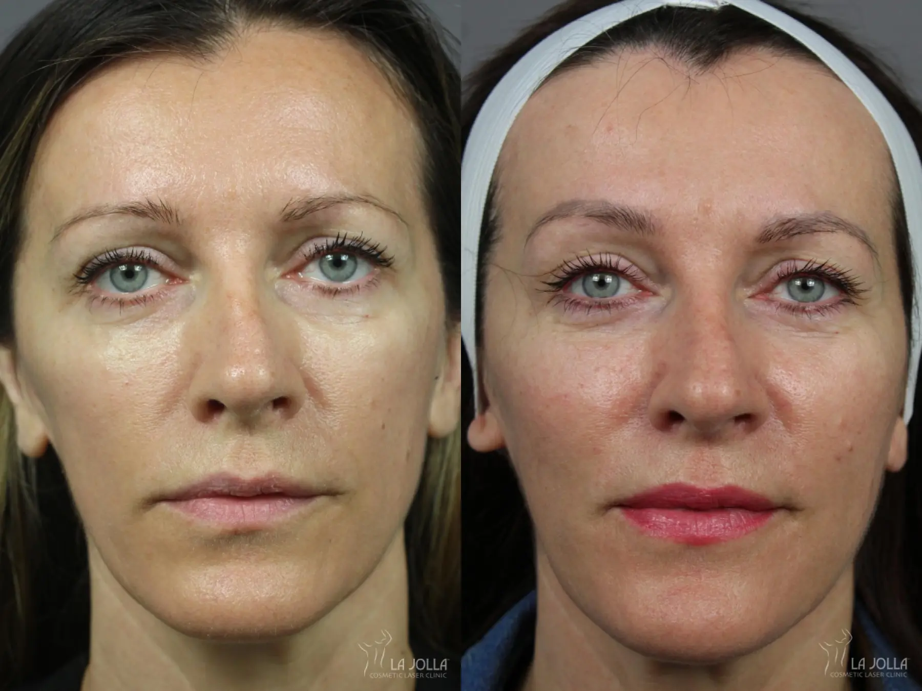 Sculptra®: Patient 20 - Before and After 1