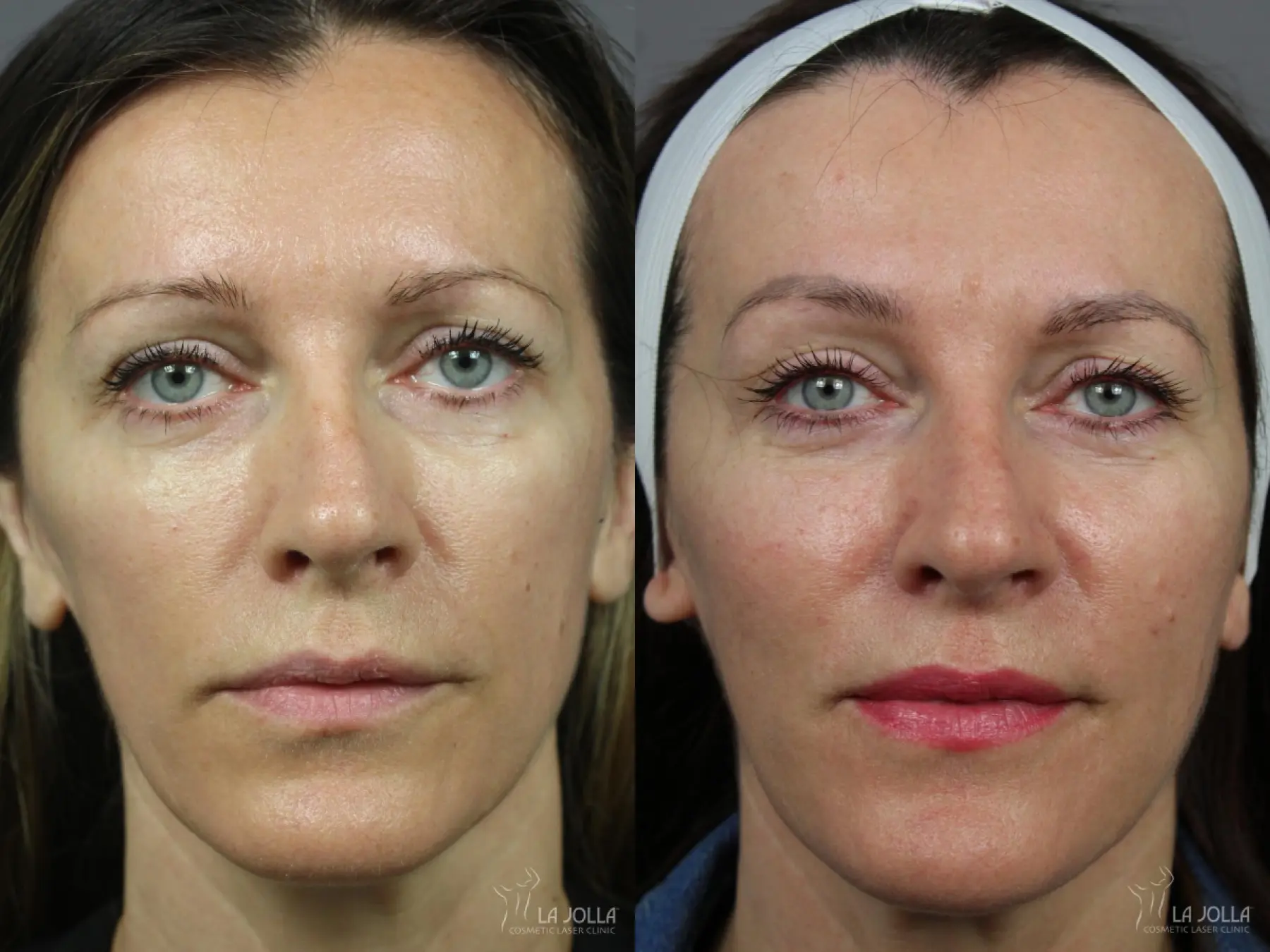 Sculptra®: Patient 23 - Before and After 1