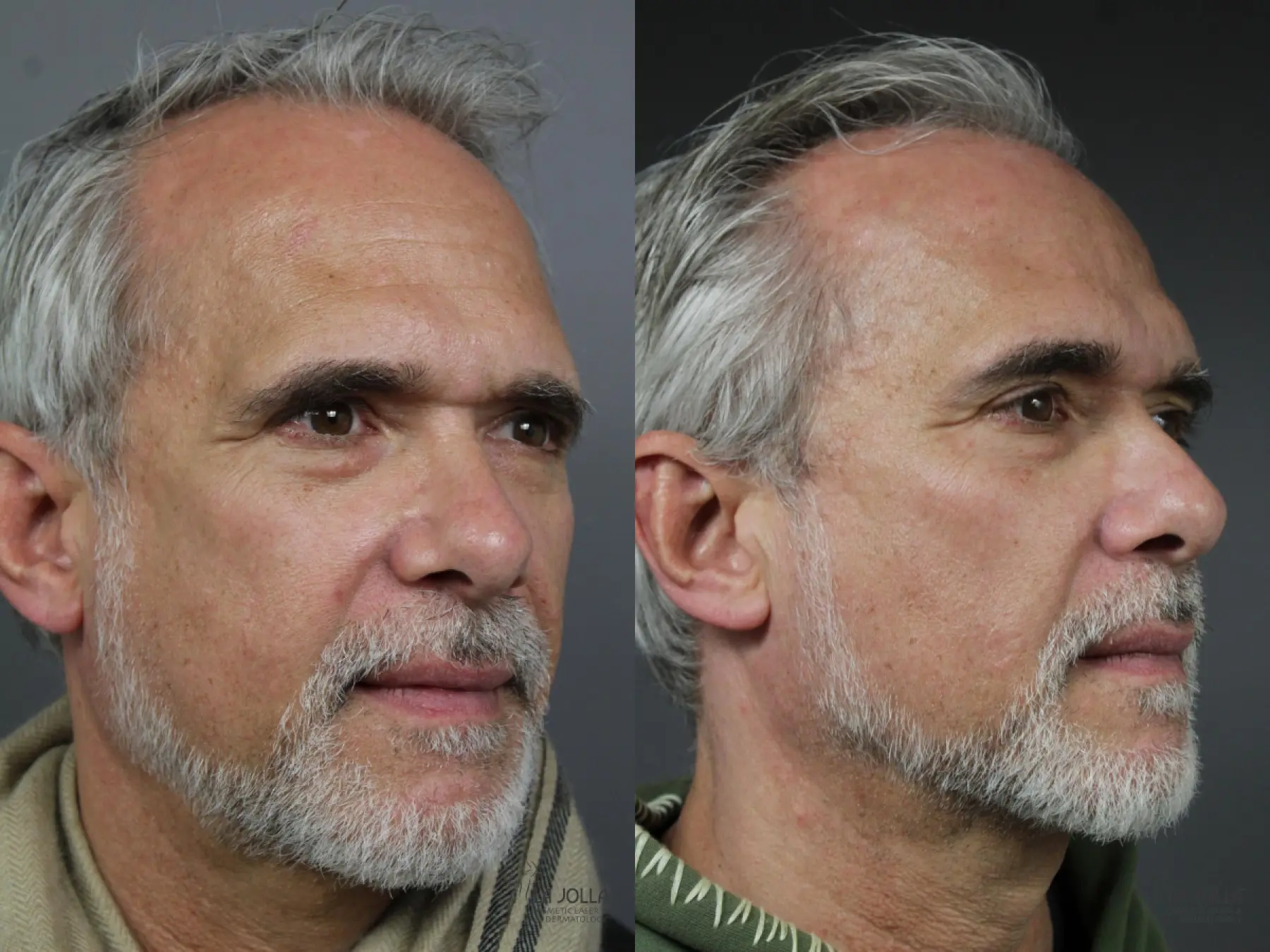 Sculptra®: Patient 1 - Before and After 3