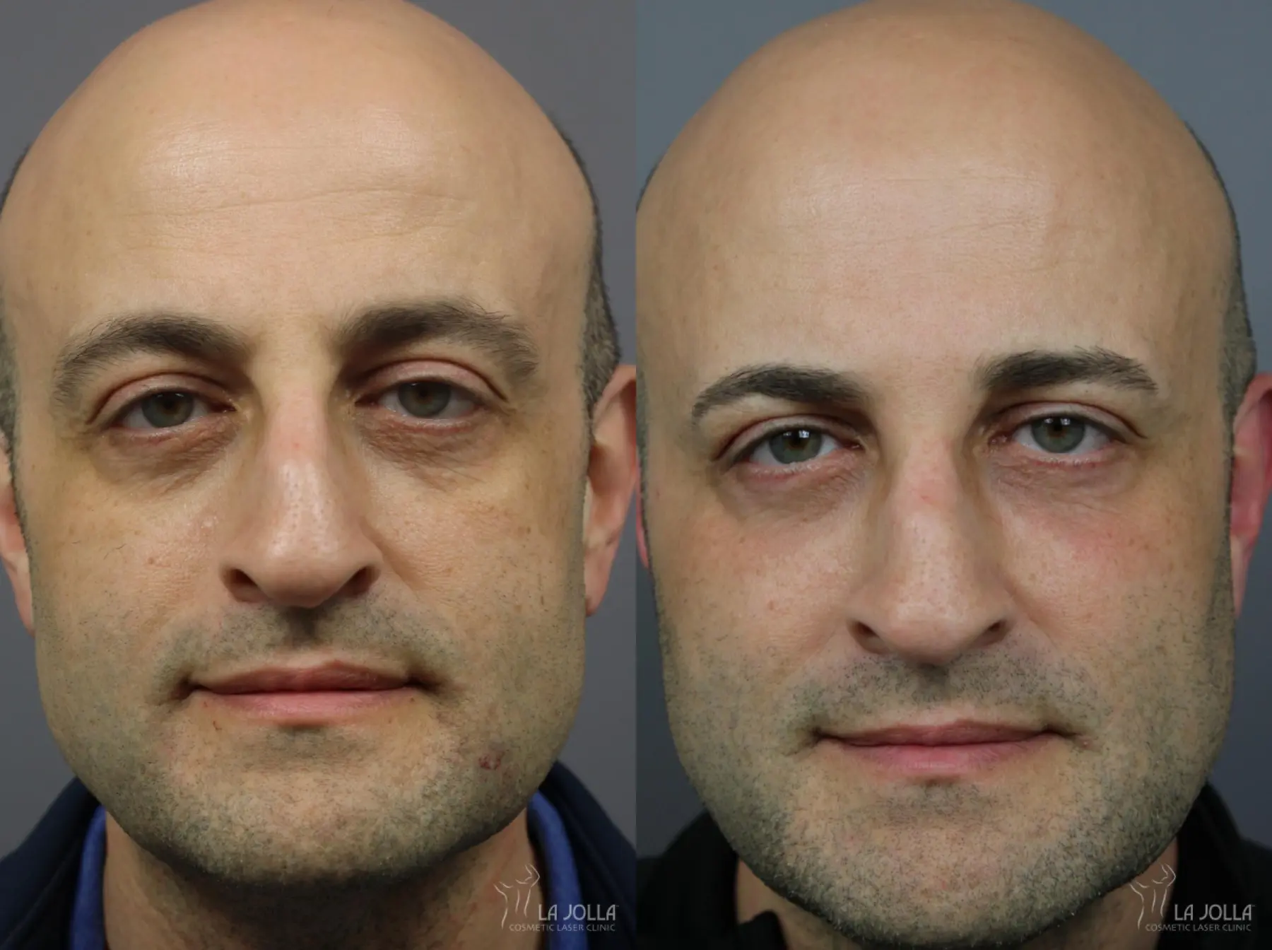 Home Patient 1 After Procedure