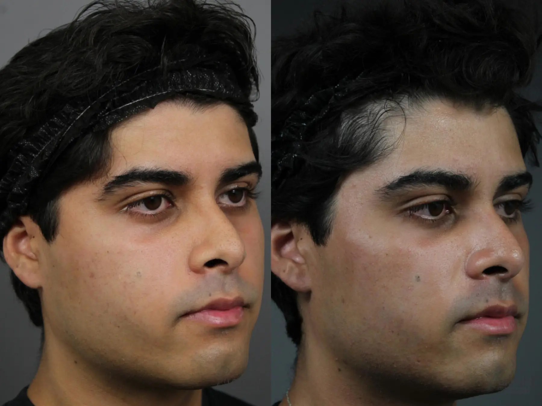 Sculptra®: Patient 2 - Before and After 2
