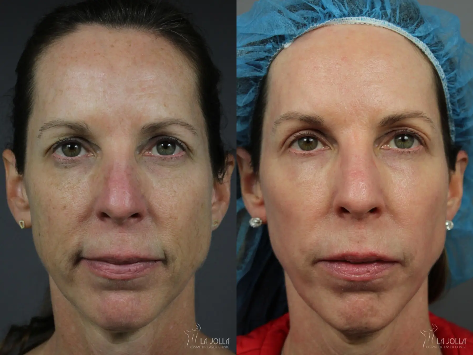 Sculptra®: Patient 19 - Before and After 1