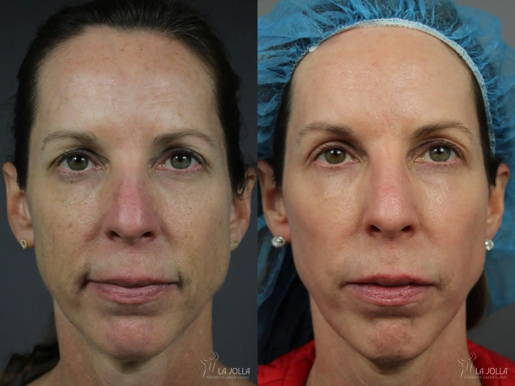 Sculptra®: Patient 22 - Before and After 1
