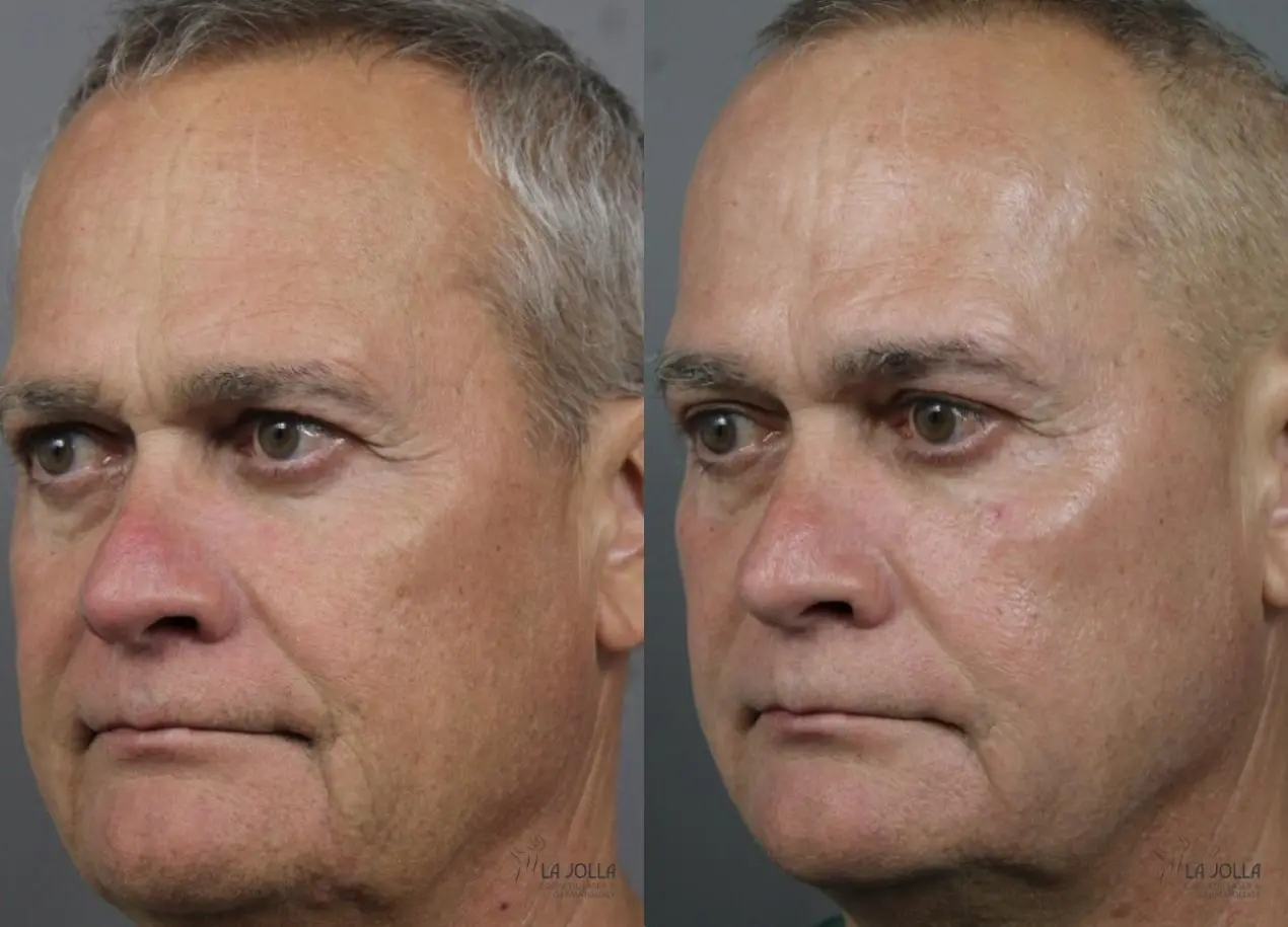 Sculptra®: Patient 2 - Before and After 3