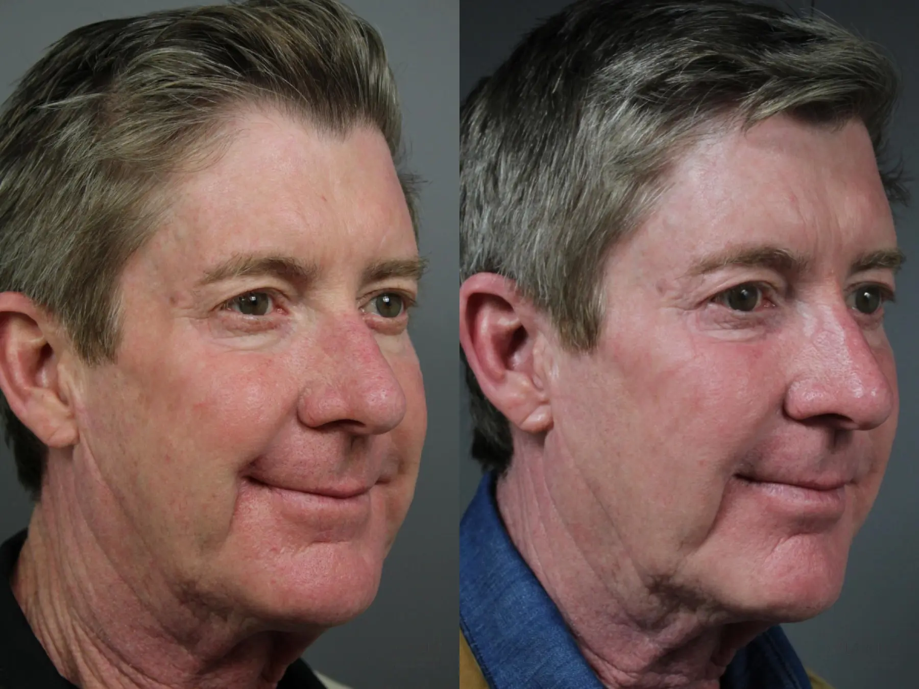Sculptra®: Patient 2 - Before and After 3
