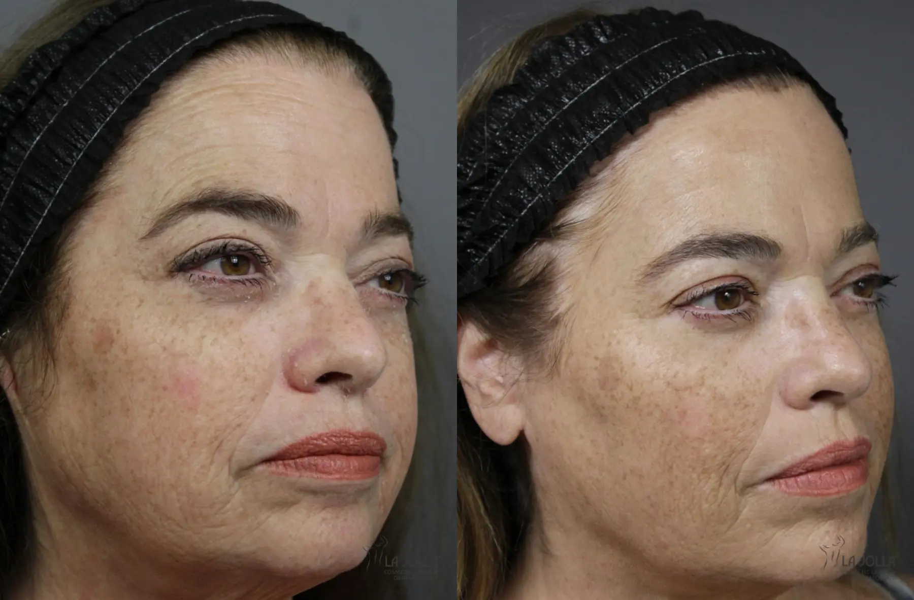 Sculptra®: Patient 1 - Before and After 3