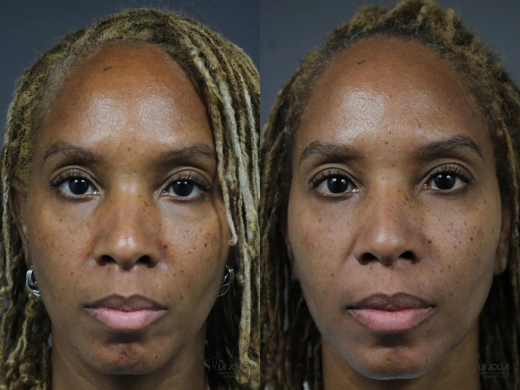 Sculptra®: Patient 1 - Before and After 1