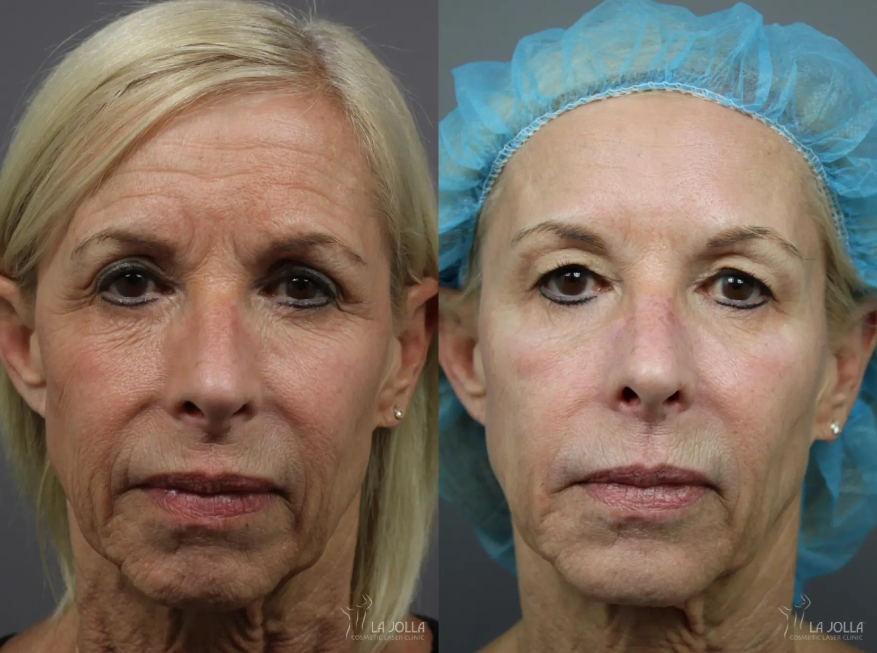 Sculptra®: Patient 12 - Before and After 1