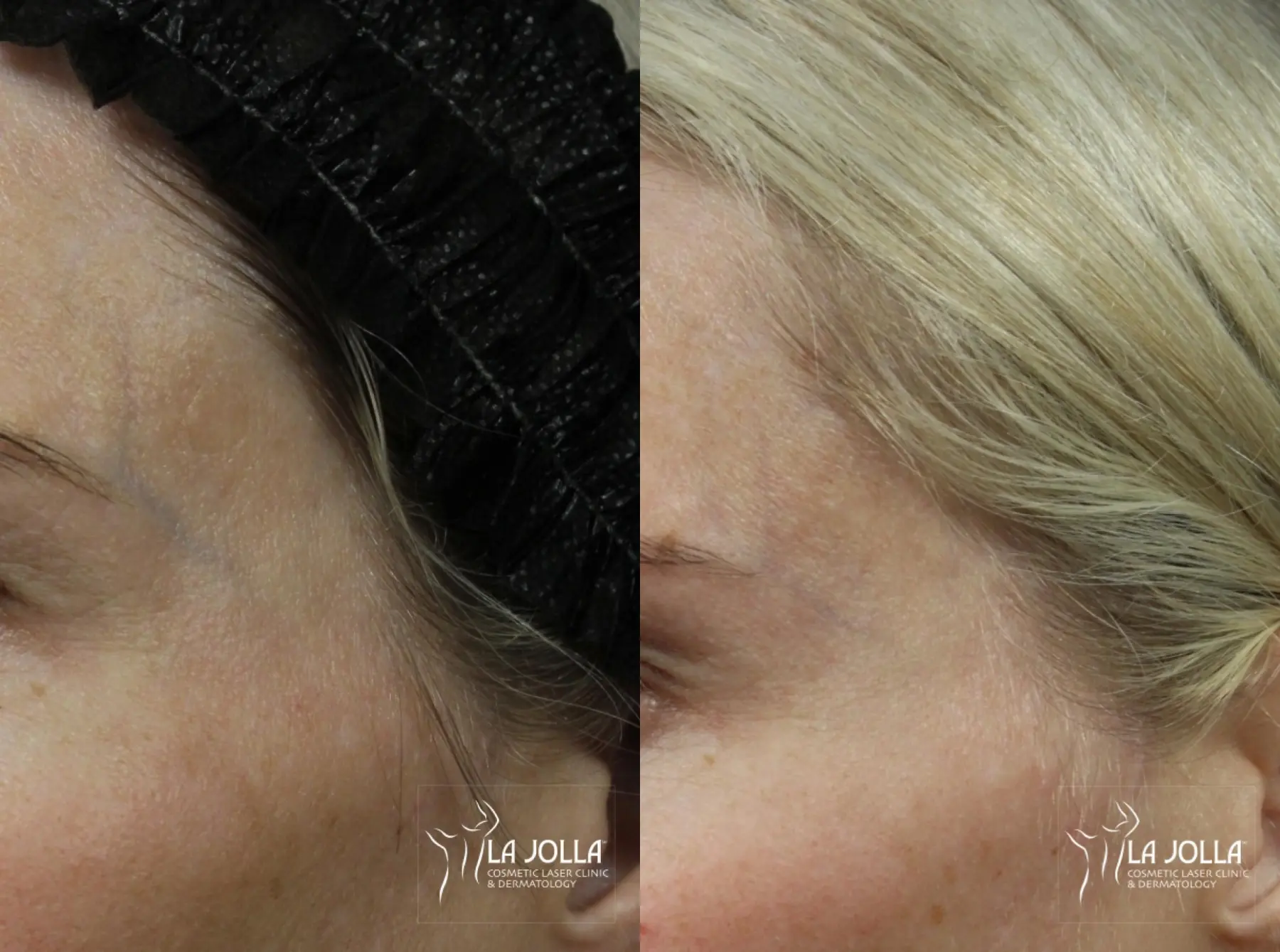 SP Dynamis: Patient 1 - Before and After  