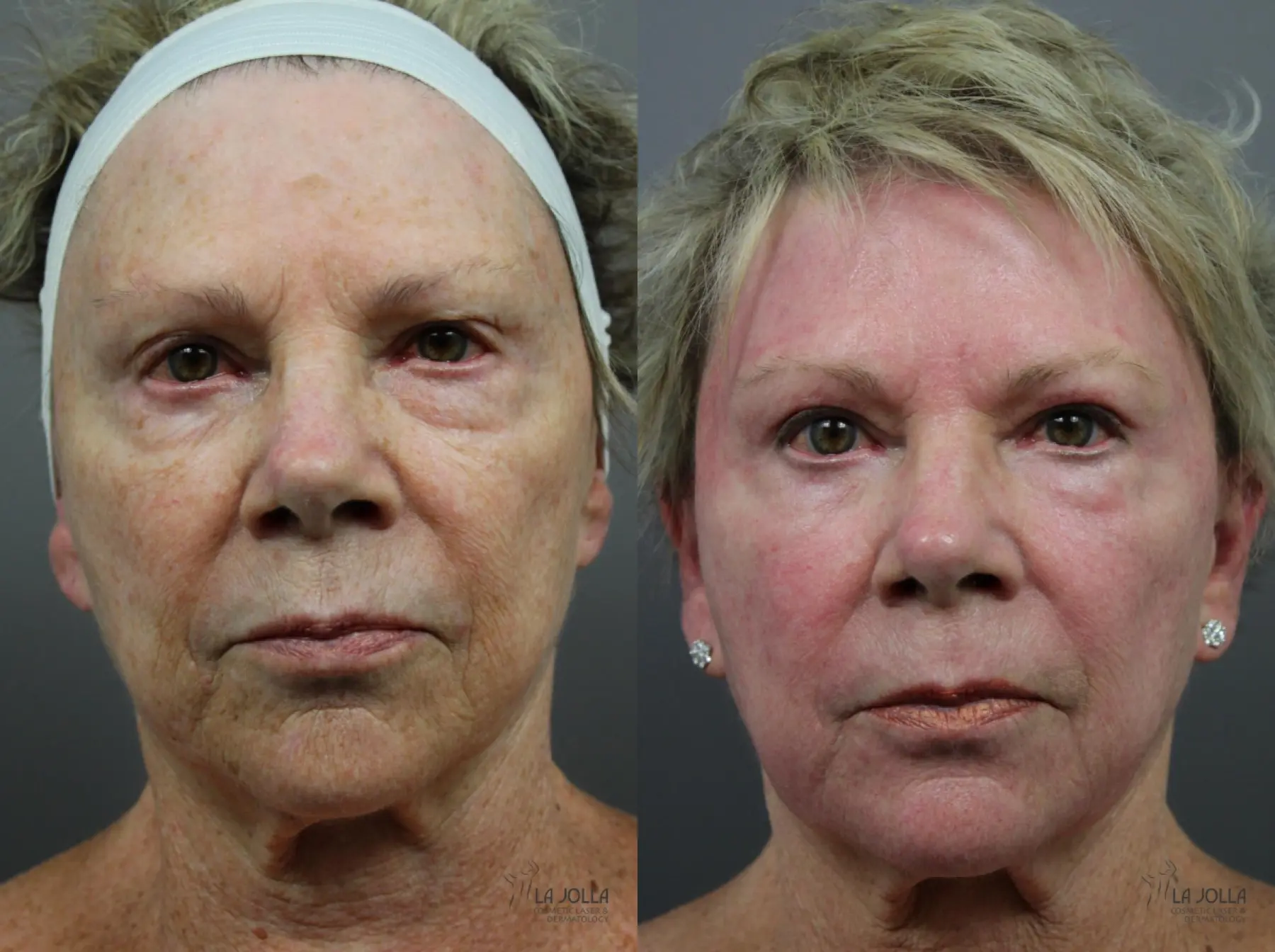 SP Dynamis: Patient 1 - Before and After 1