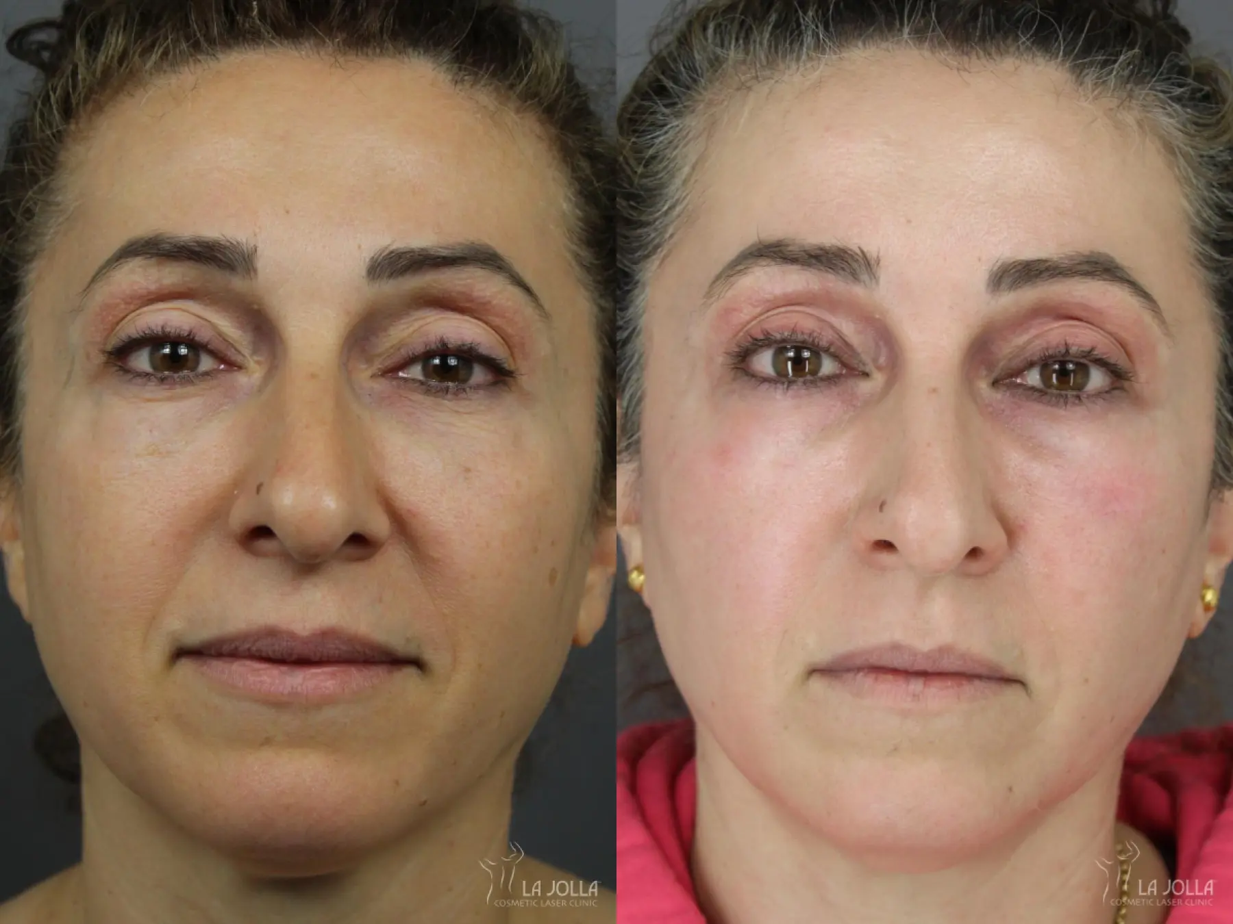 SP Dynamis: Patient 51 - Before and After 1