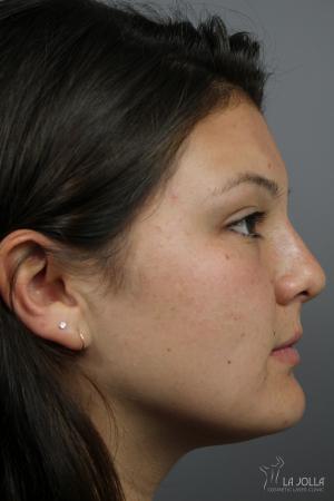 Non-Surgical Nose Job: Patient 5 - After  