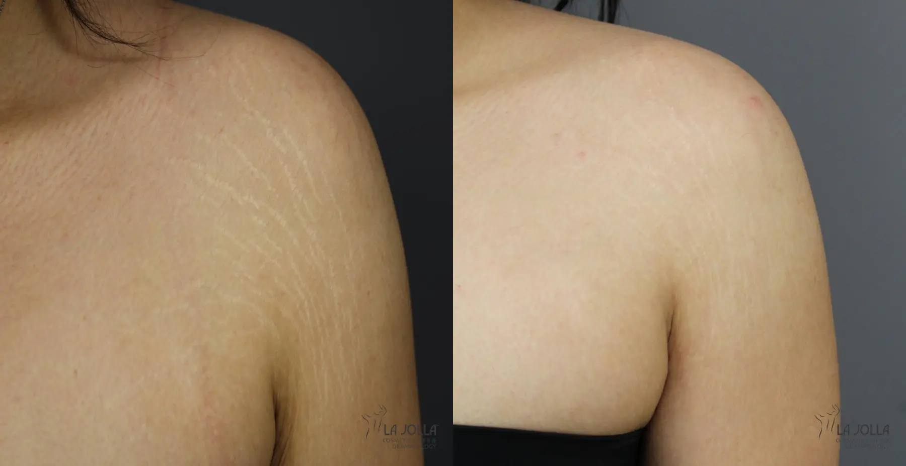 StarWalker® Laser: Patient 1 - Before and After 2