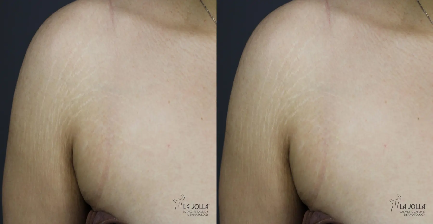 StarWalker® Laser: Patient 1 - Before and After  