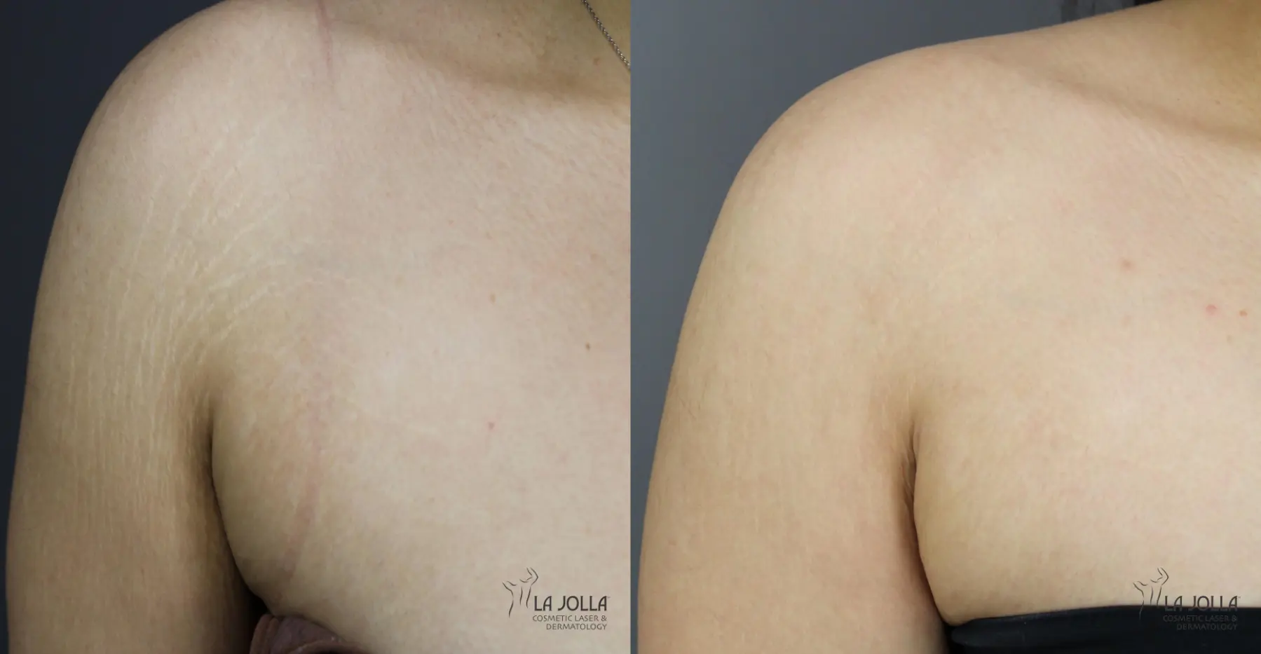 StarWalker® Laser: Patient 1 - Before and After 2