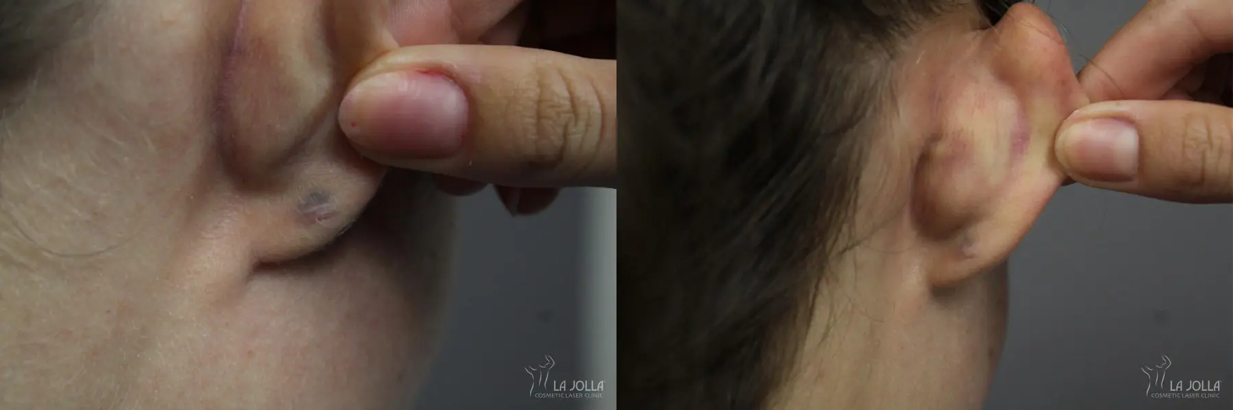 StarWalker® Laser: Patient 2 - Before and After 2