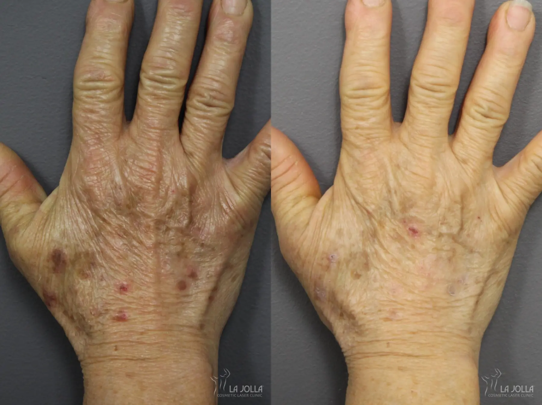 StarWalker® Laser: Patient 11 - Before and After 1