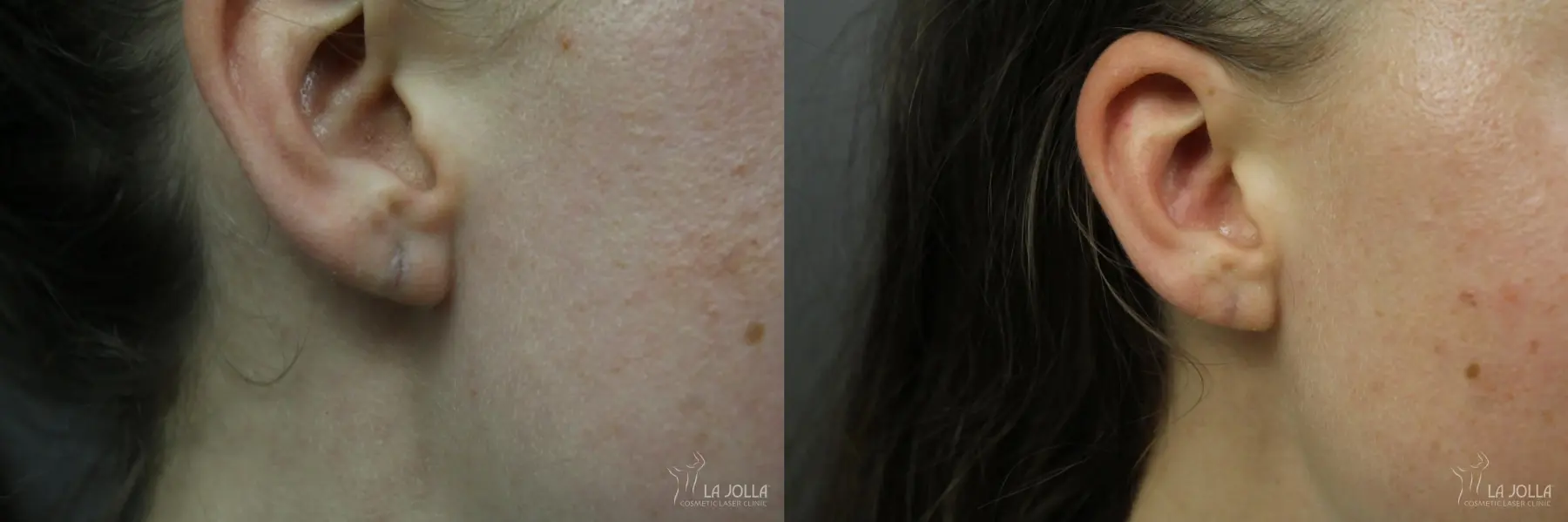 StarWalker® Laser: Patient 2 - Before and After  