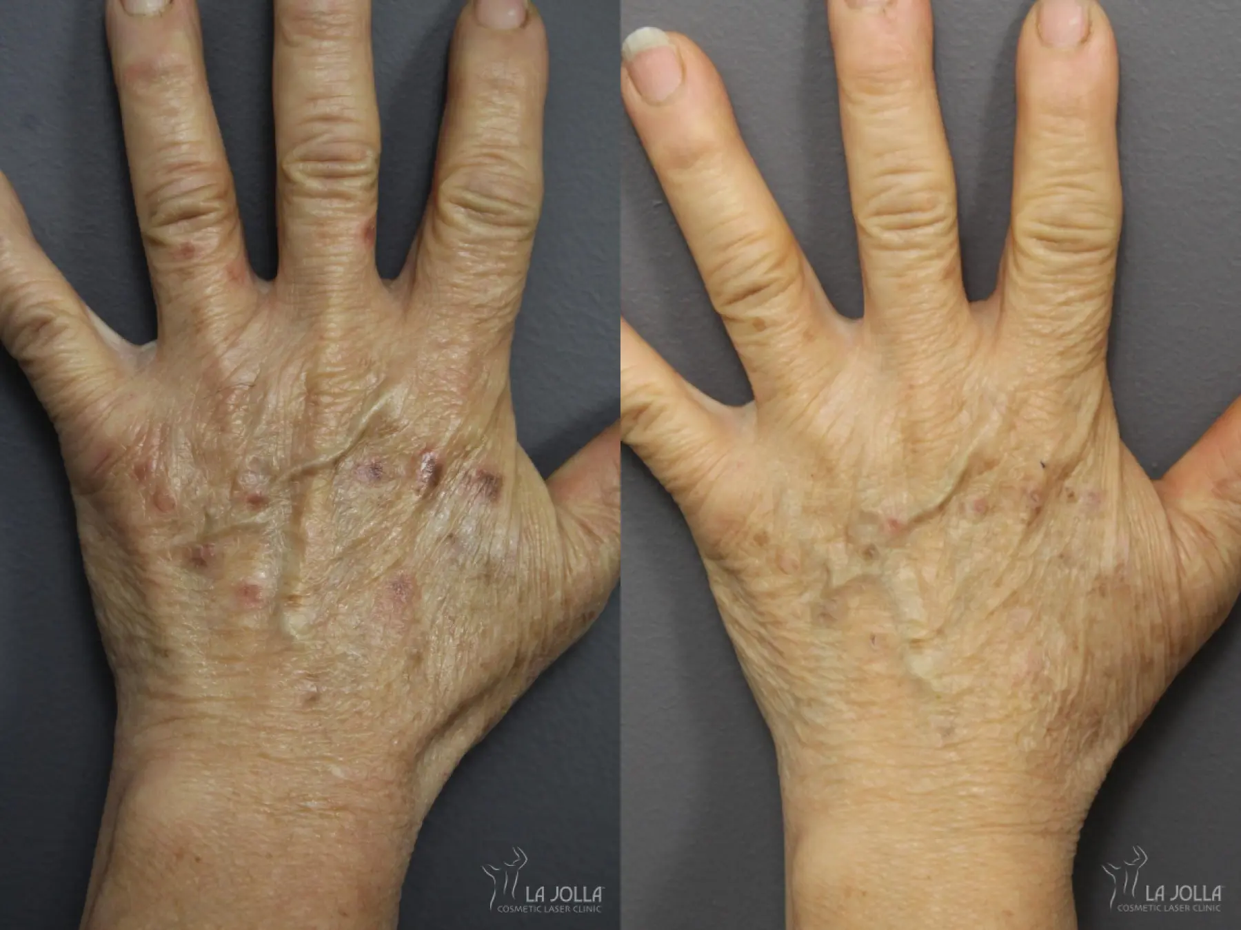 StarWalker® Laser: Patient 13 - Before and After 2