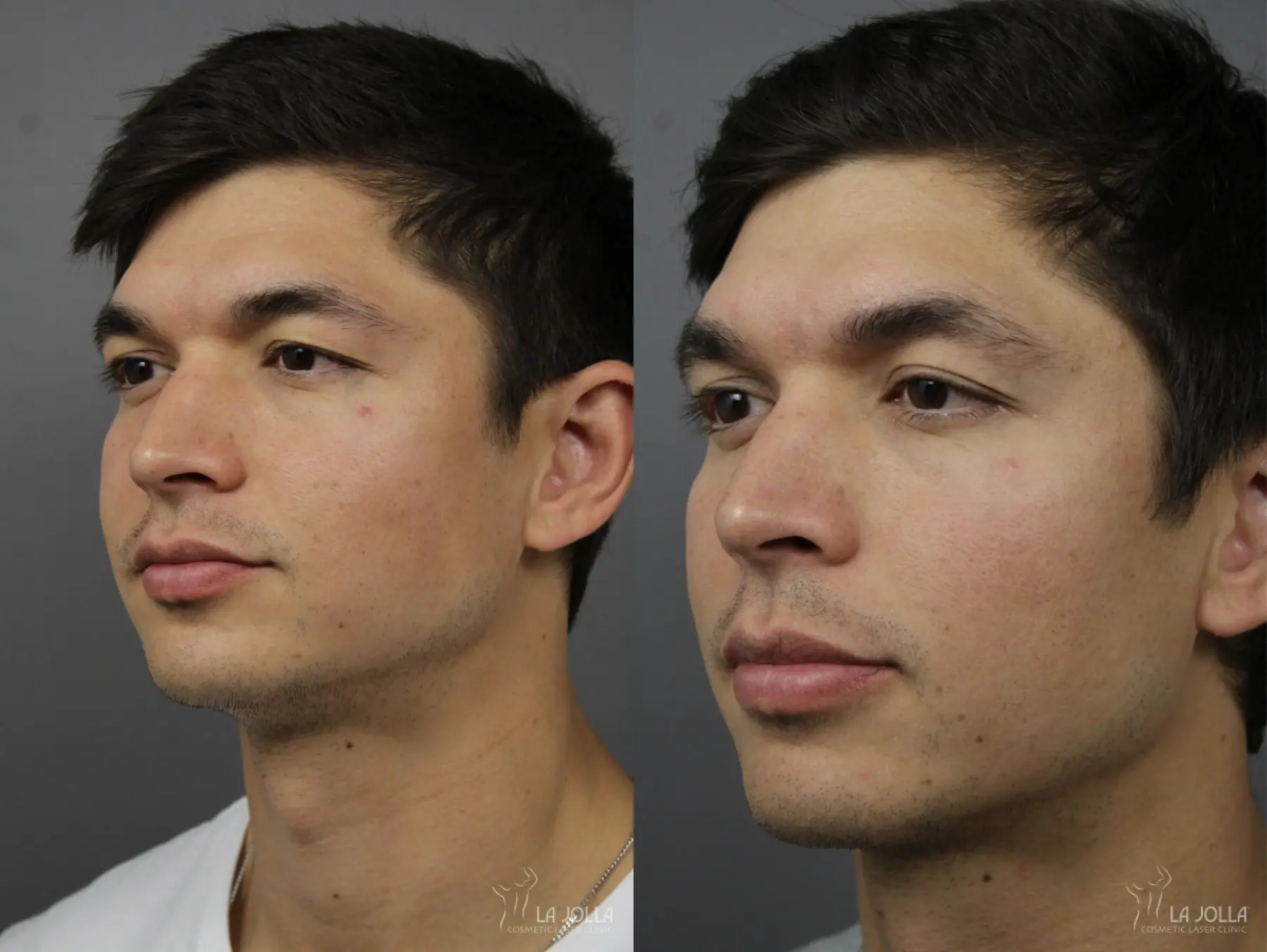 StarWalker® Laser: Patient 2 - Before and After 1
