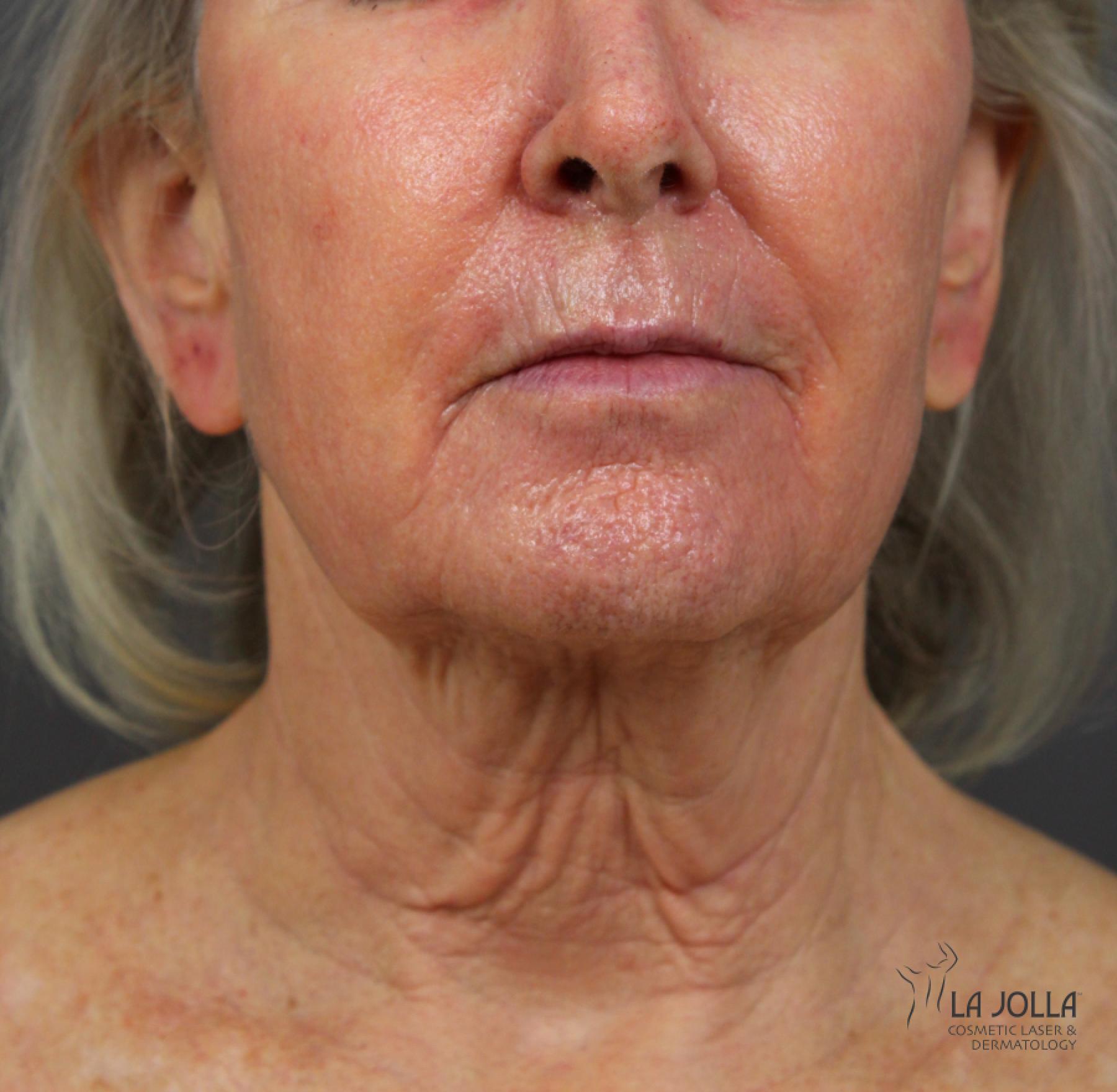 CO2 Laser: Patient 4 - After  