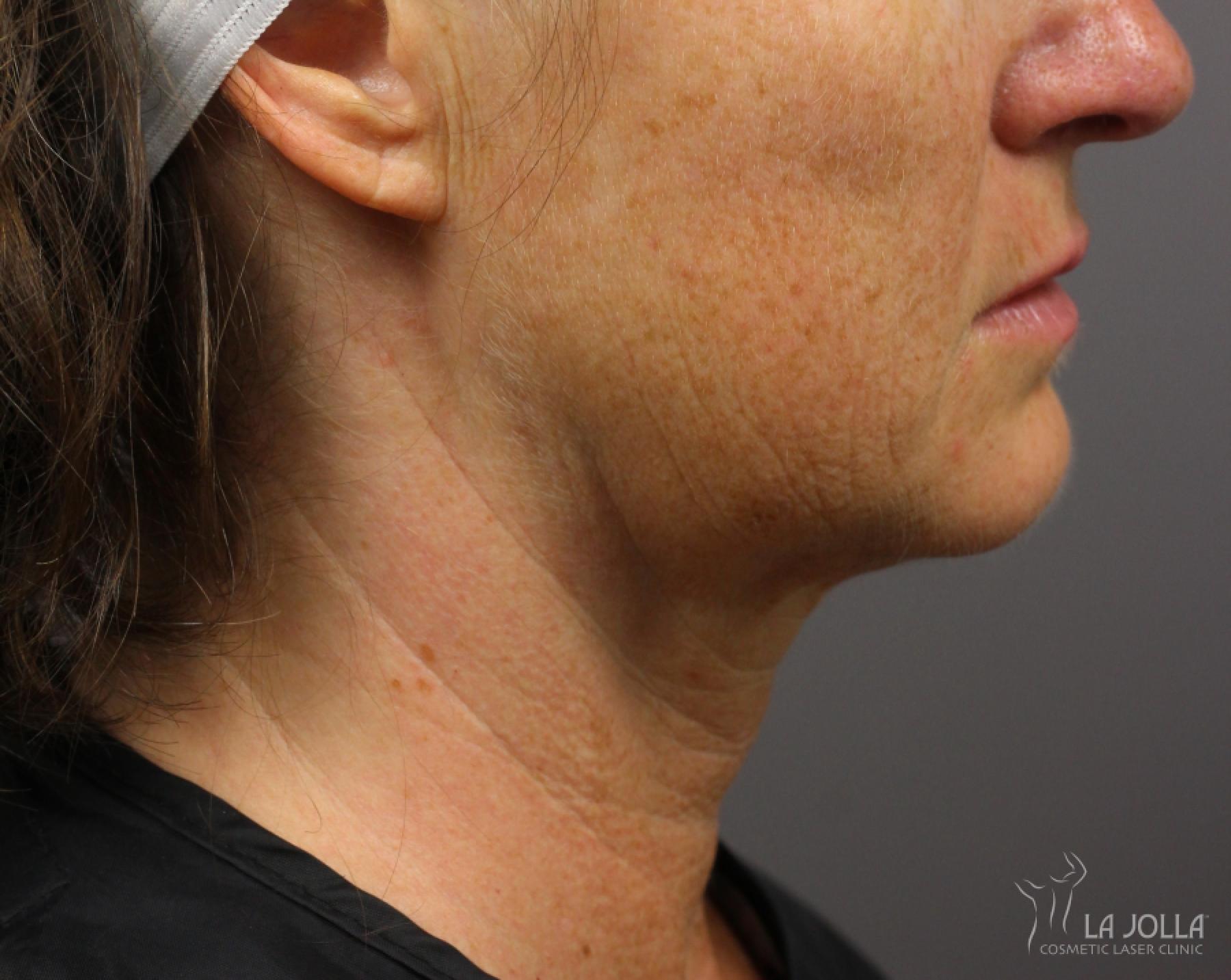 Kybella: Patient 7 - After 1