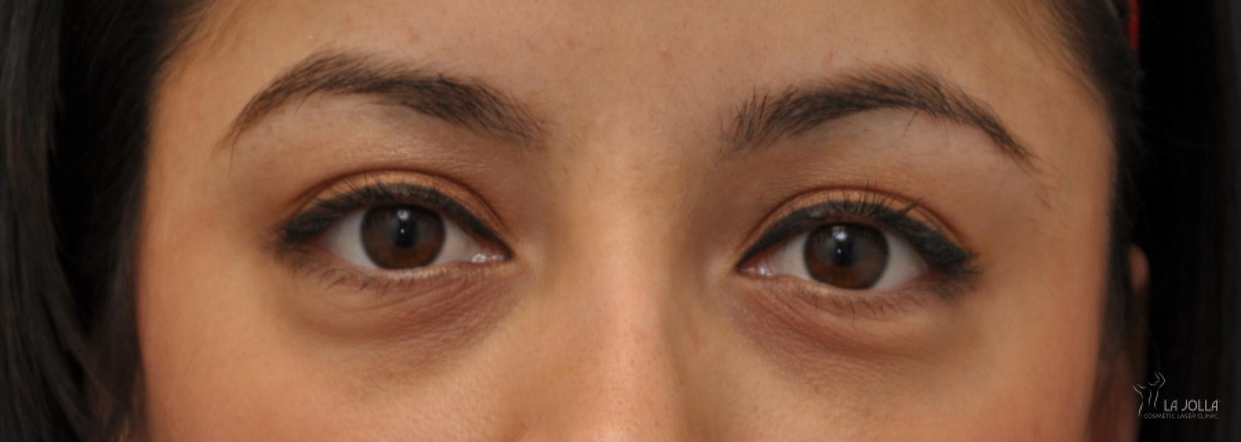 Under Eye Filler: Patient 4 - Before 1