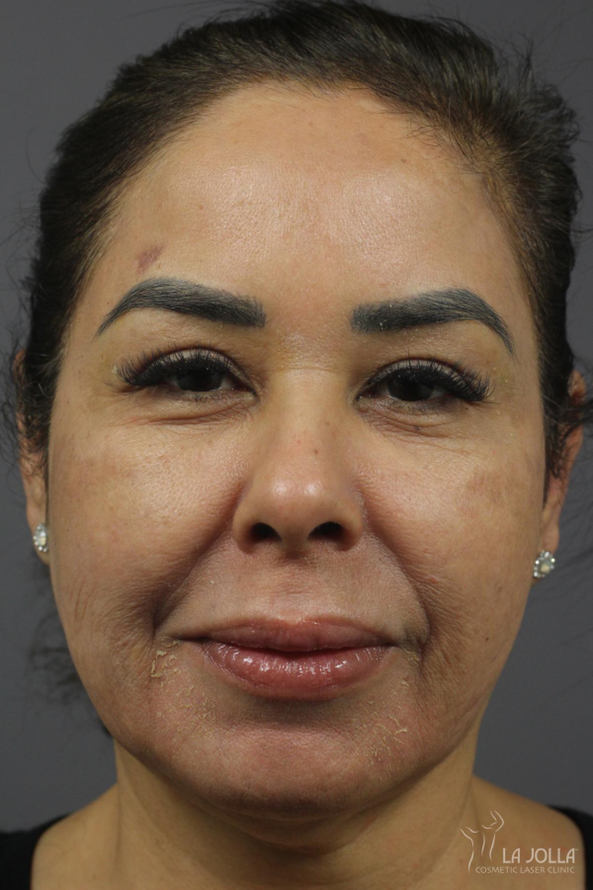 Chemical Peel: Patient 2 - After 1