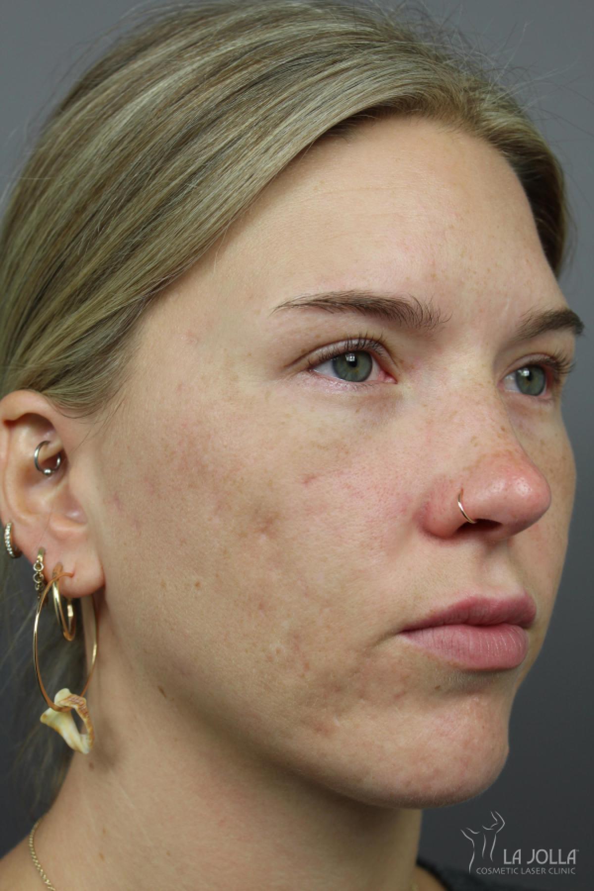 Acne Rejuvenation: Patient 4 - After 1