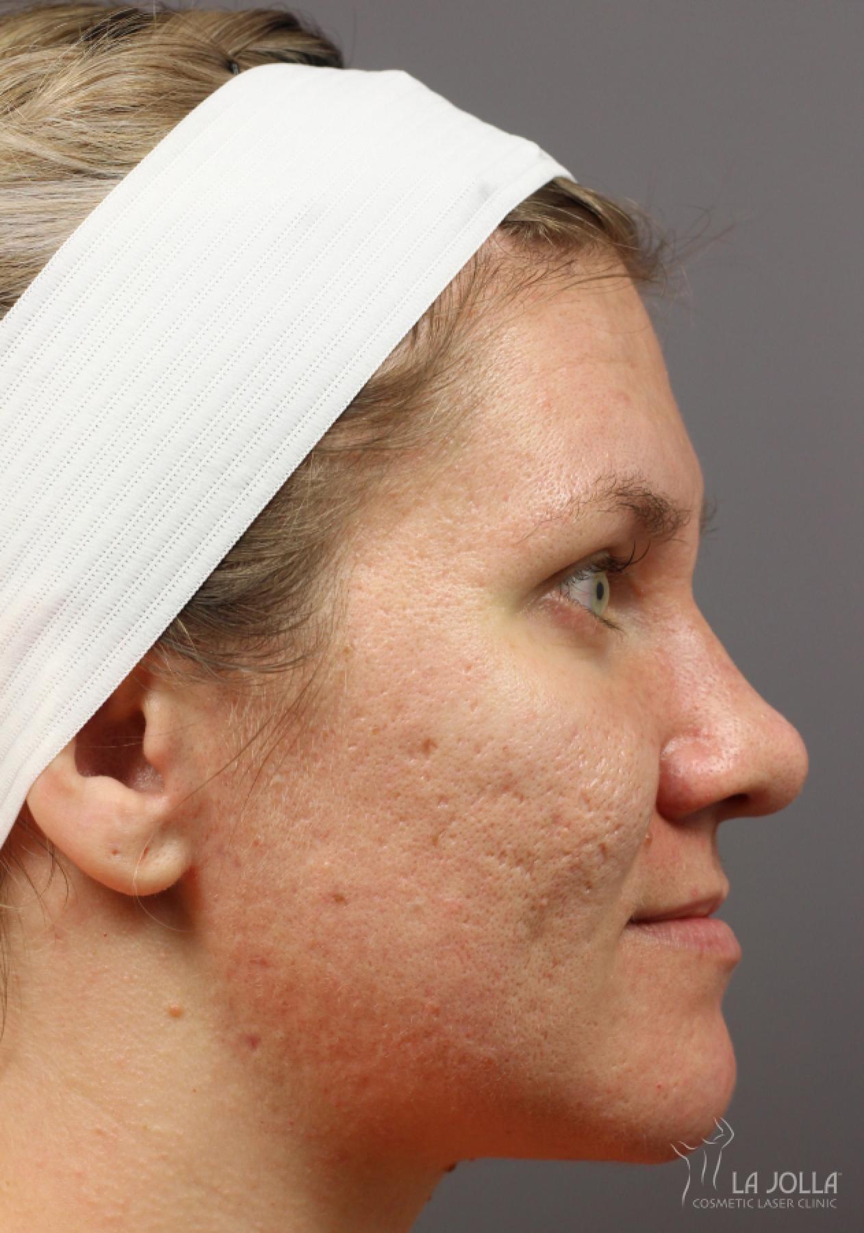 Acne Scars: Patient 8 - Before 