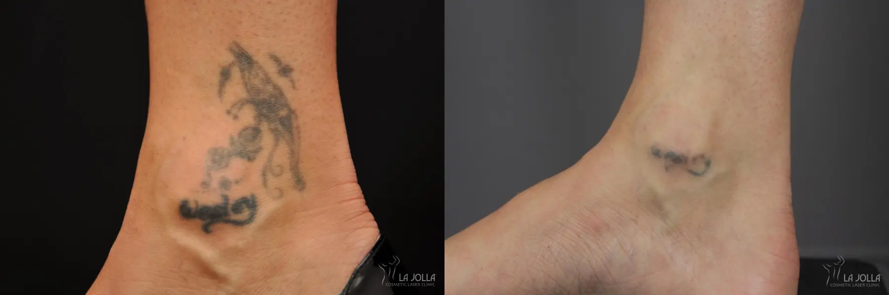 Tattoo Removal: Patient 2 - Before and After 1