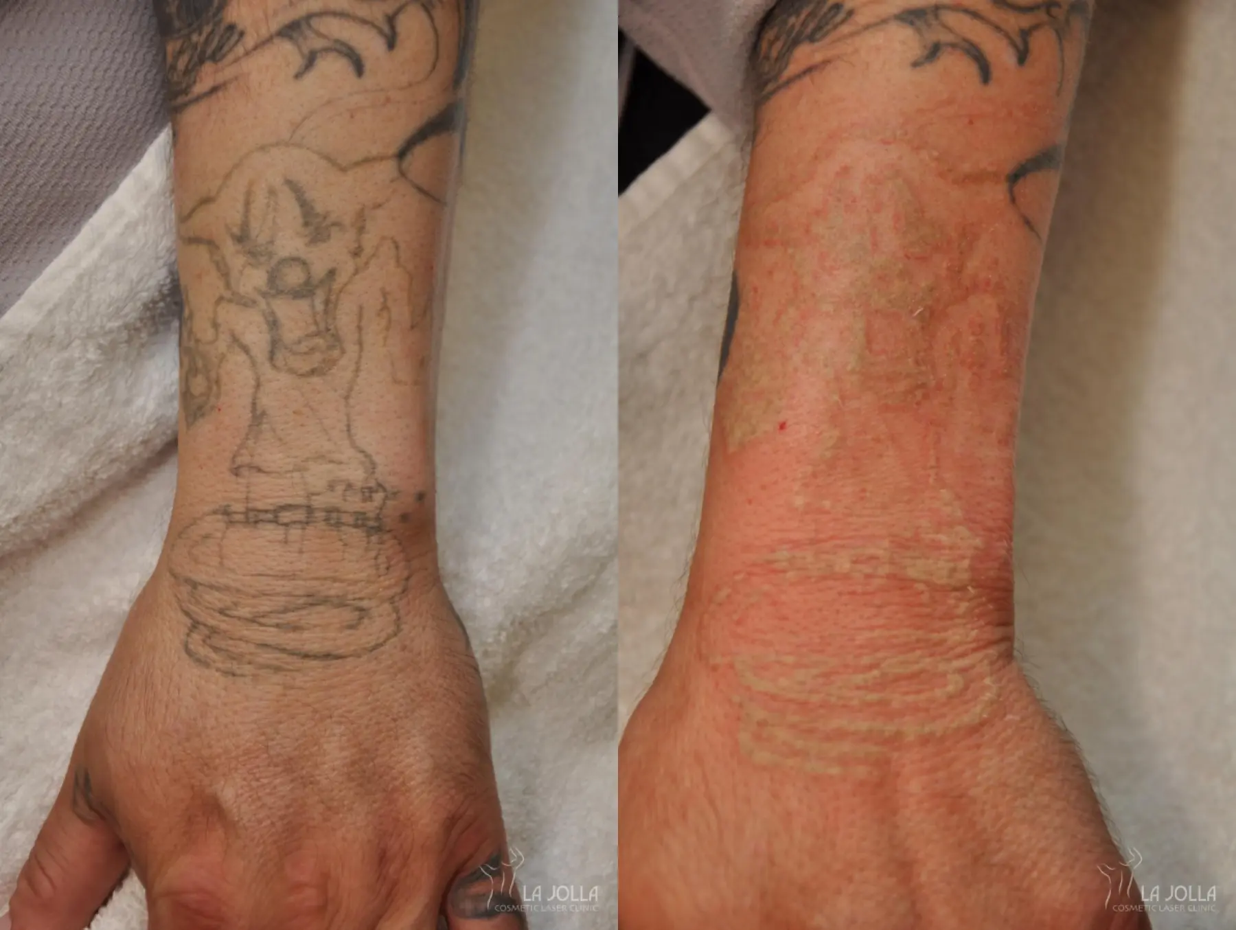 Tattoo Removal: Patient 1 - Before and After  