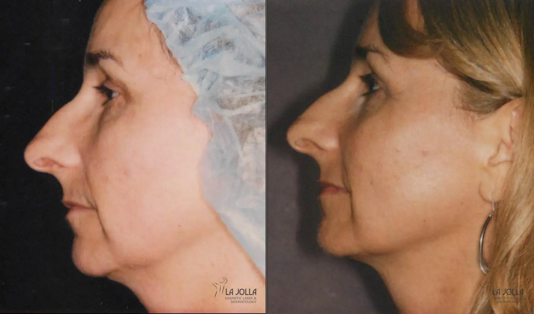 Thermage: Patient 5 - Before and After  