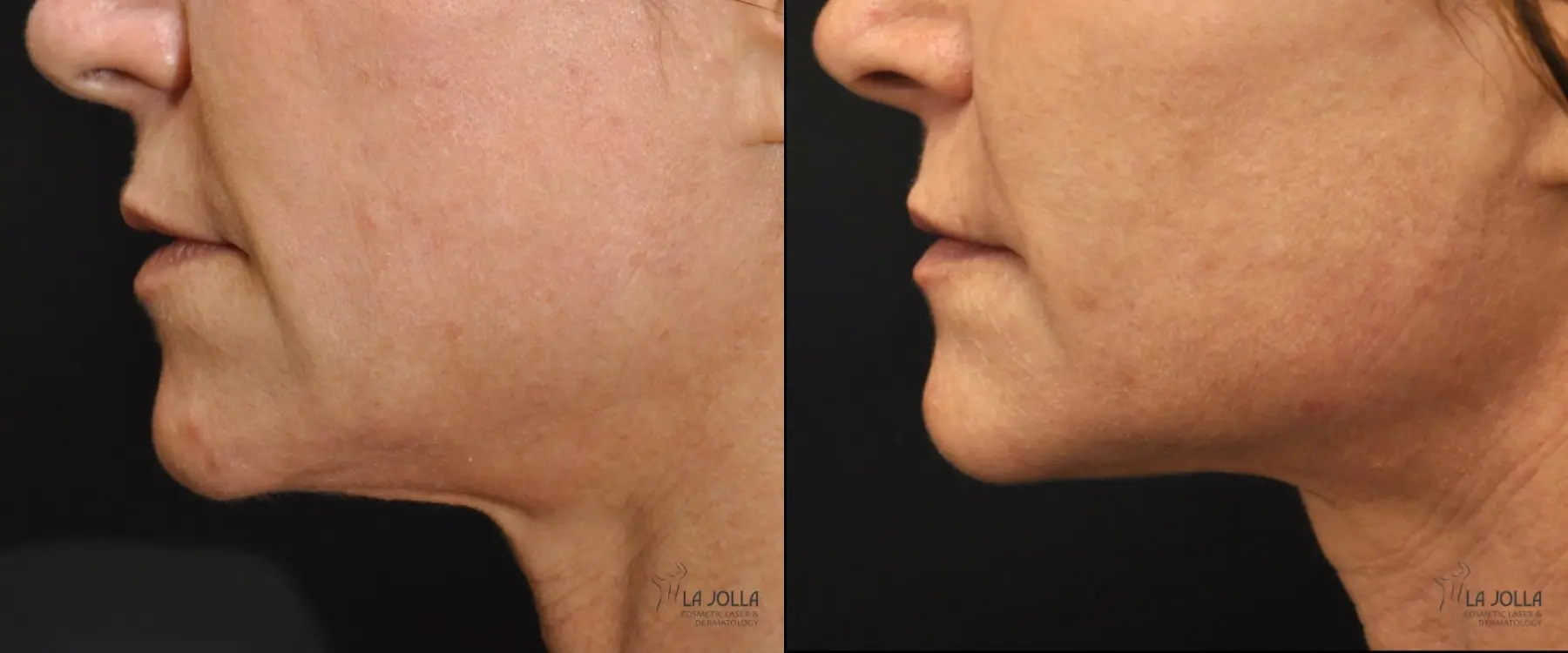 Thermage: Patient 9 - Before and After  