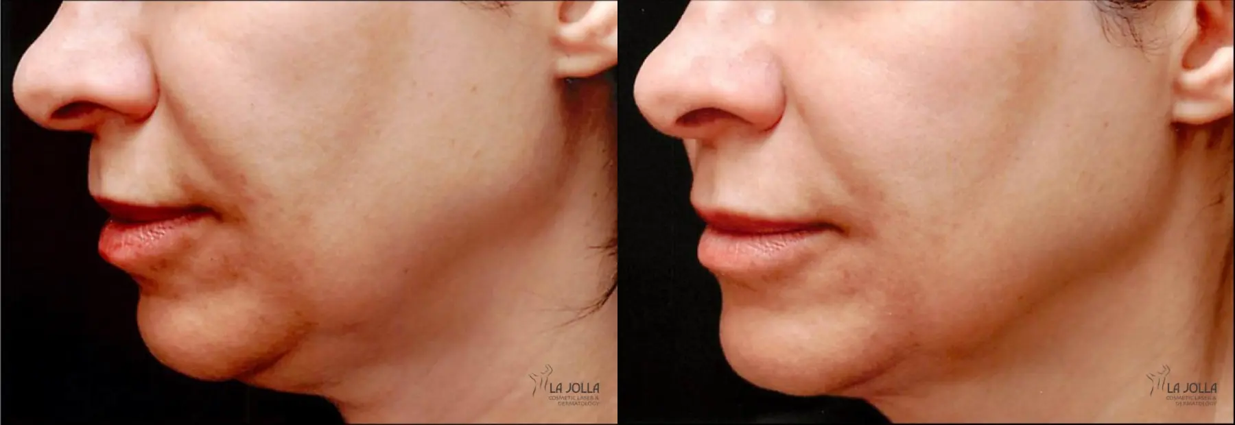Thermage: Patient 7 - Before and After  